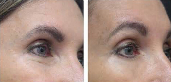 skin-tightening-eyes-before-after.jpg