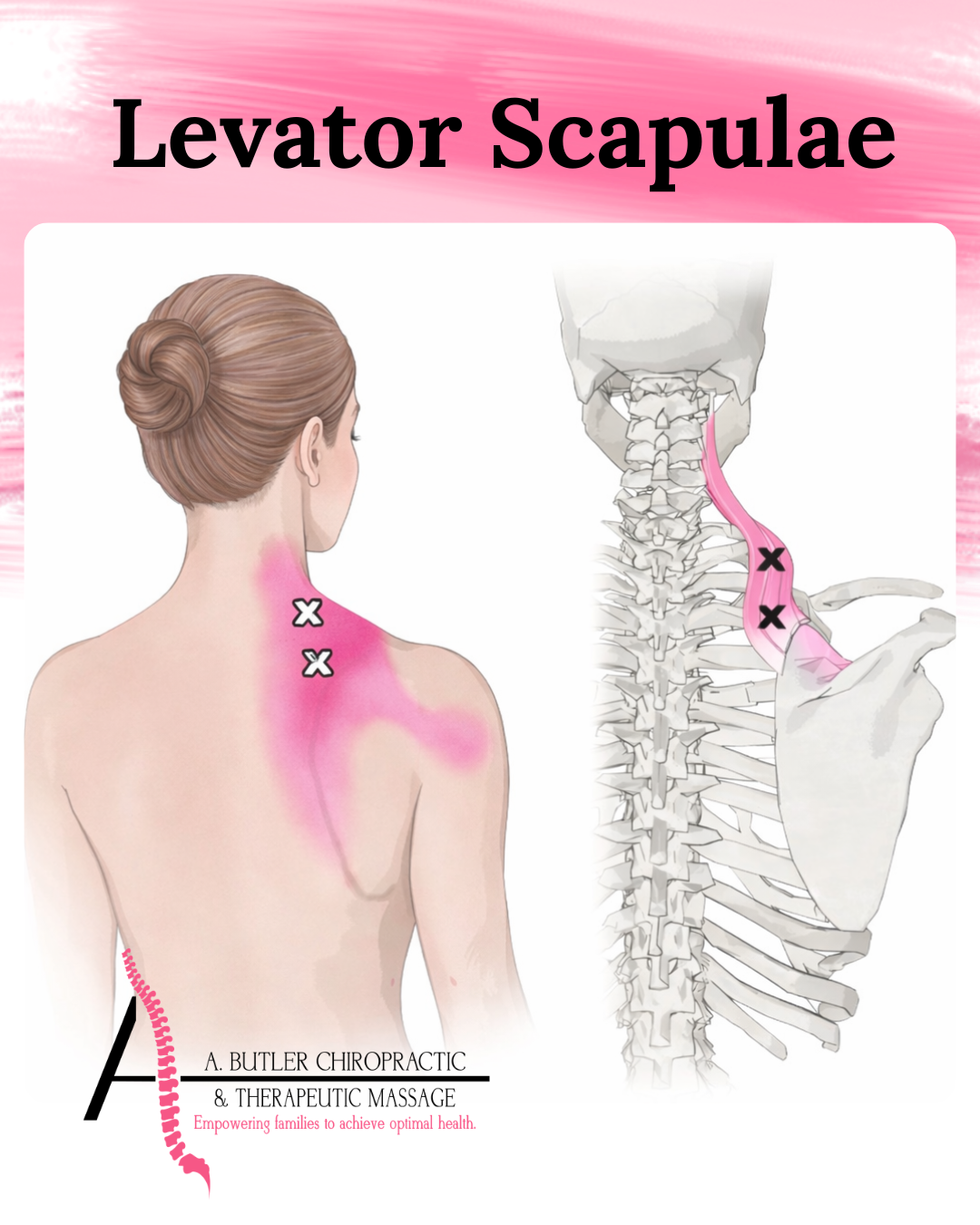 That “Knot” in Your Shoulder That Never Goes Away