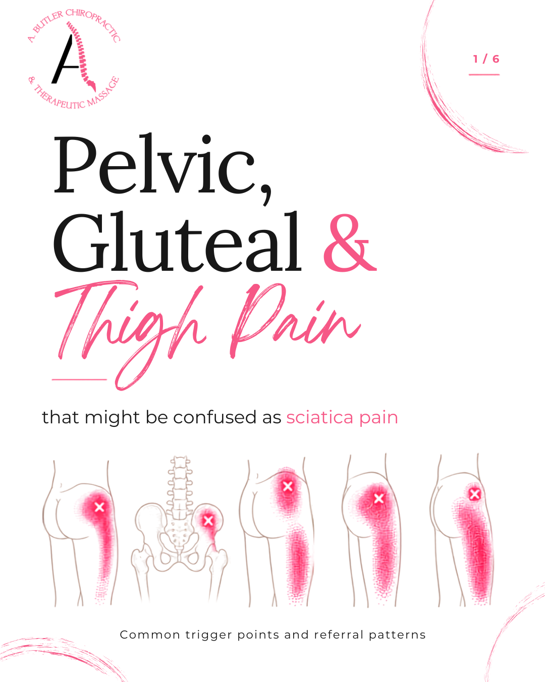 Momma Hip: When Outer Hip, Gluteal, and Thigh Pain Feels Like Sciatica