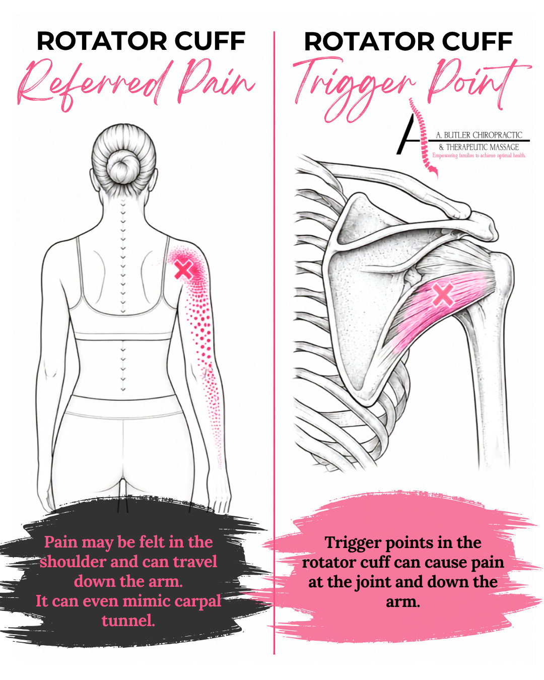 Rotator cuff trigger points causing referred shoulder pain down the arm.
