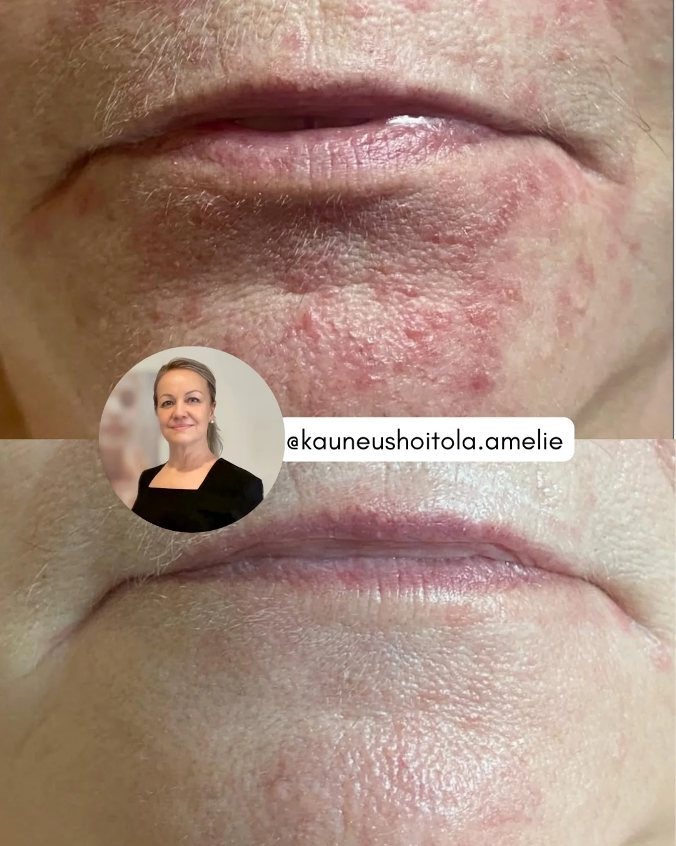 Lokakuu on Yhdysvalloissa Eczema Awareness Month ja haluamme nostaa aiheen esiin my&ouml;s t&auml;&auml;ll&auml; &ndash; erityisesti, kun @kauneushoitola.amelie Sanna jakoi vaikuttavan hoitotuloksen ihottuman hoidosta 💜

BiON-ammattilaiset tekev&aum