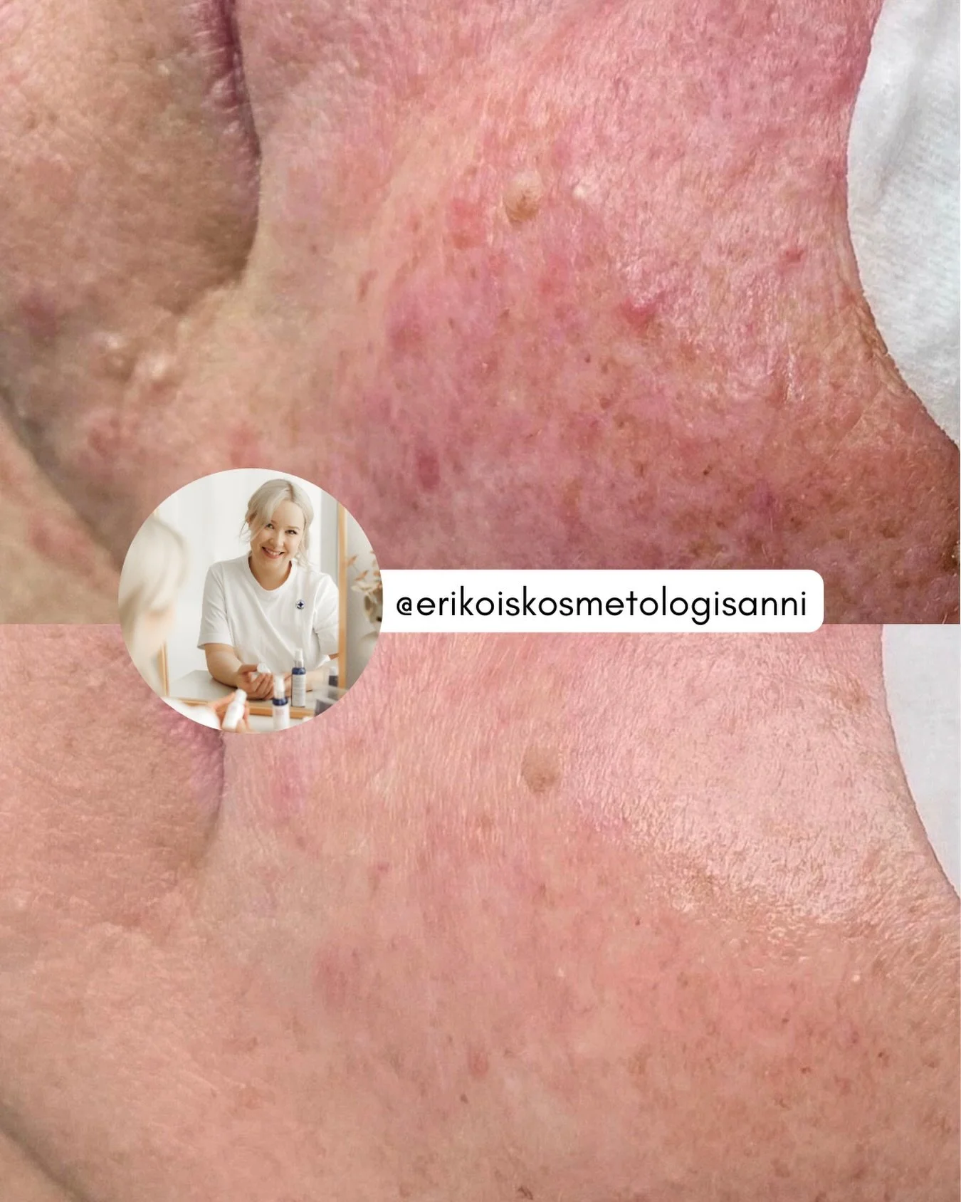 Aloitetaan vuoden 2026 somepostaukset inspiroivissa merkeiss&auml; t&auml;ll&auml; UPEALLA ihomuutoksella✨

Talvi ja kovat pakkaskelit voivat herkist&auml;&auml; ruusufinni-ihoa entisest&auml;&auml;n. Viima, kylm&auml; ja nopeat l&auml;mp&ouml;tilava