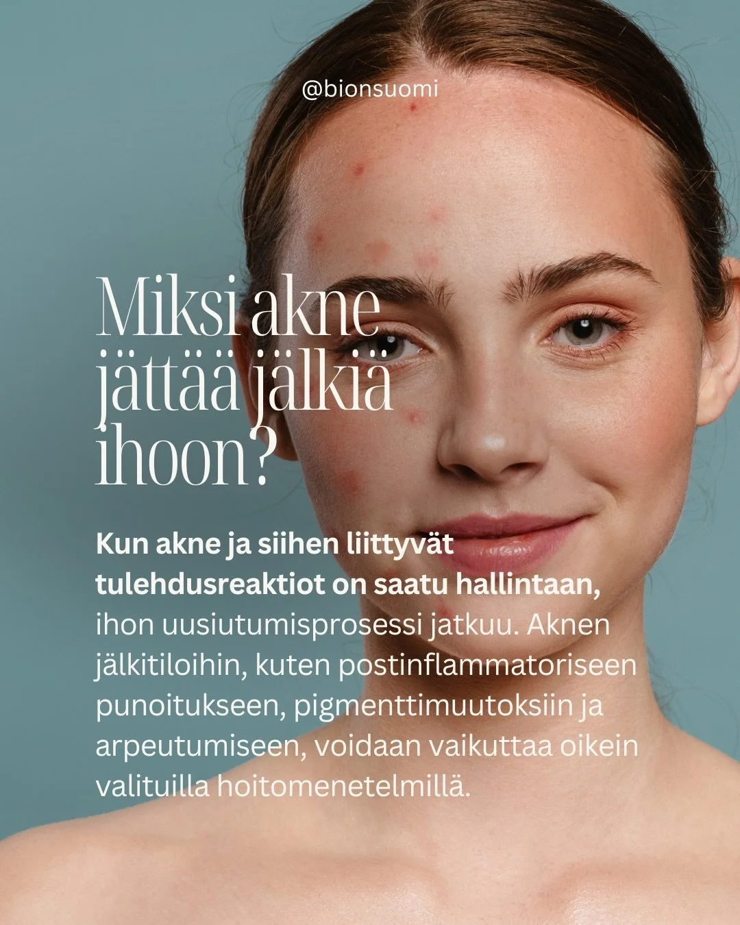 Aknen hoito etenee usein kahdessa vaiheessa. 🩵Ensimm&auml;isess&auml; vaiheessa keskityt&auml;&auml;n aknen hallintaan ja ihon toiminnan tasapainottamiseen, mukaan lukien talinerityksen, keratinisaation ja mahdollisten tulehdusreaktioiden s&auml;&au