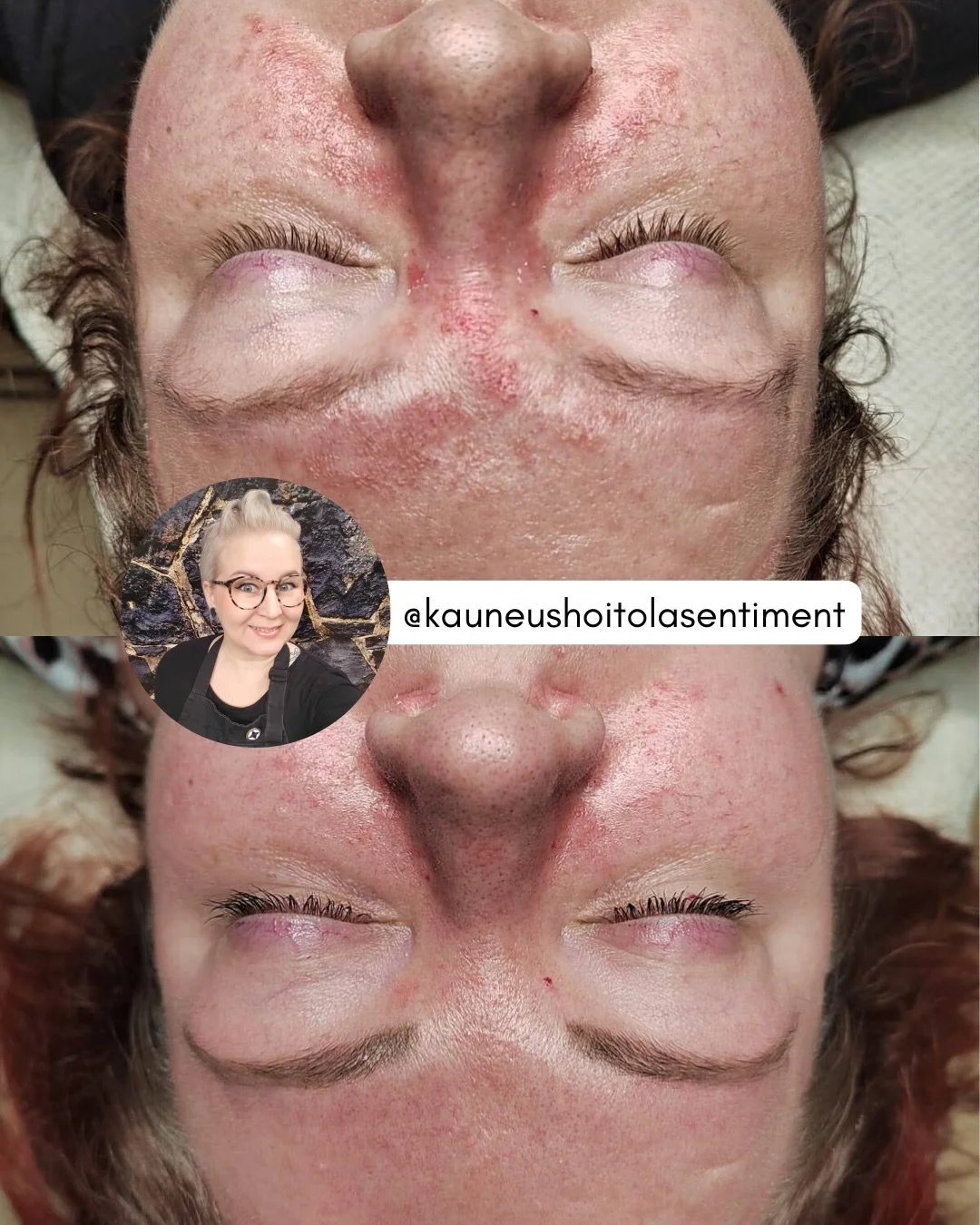 T&auml;m&auml; vuosi on startannut kyll&auml; upeilla ihomuutoksilla! 💫

Jaamme hoitotuloksen, joka havainnollistaa, mit&auml; oikein rakennettu kotihoito ja vahva ammattiosaaminen voivat saada aikaan. Kuvien v&auml;lill&auml; on 8 viikkoa ja tulos 