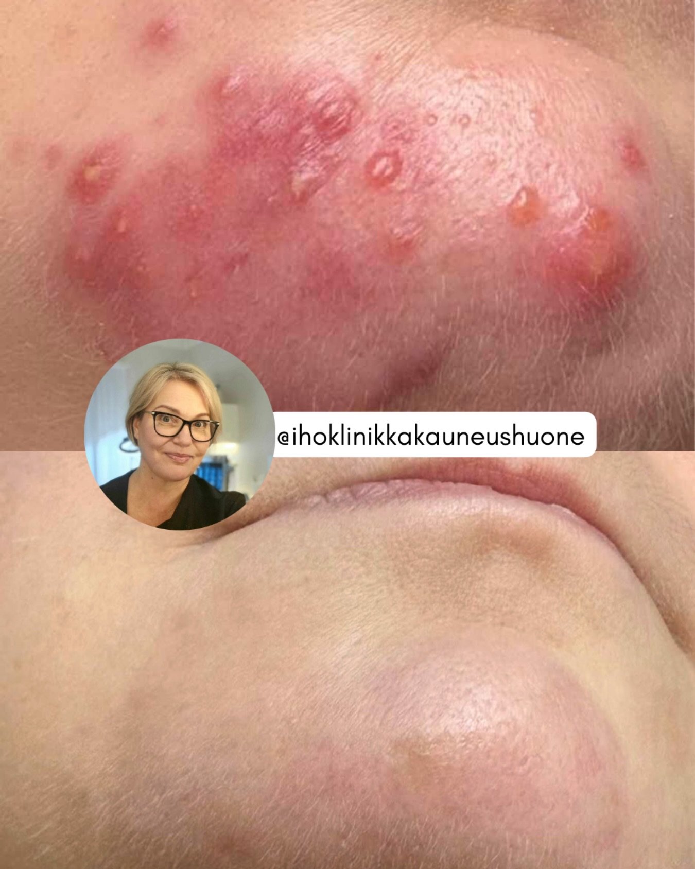 Aloitetaan viikonloppu inspiroivissa merkeiss&auml; j&auml;lleen upealla hoitotuloksella ☀️

Aknen ja ruusufinnin hoito ei ole sattumaa. Tulokset syntyv&auml;t kokonaisuudesta, jossa yhdistyv&auml;t ihon biokemiaan pohjautuva hoitometodimme sek&auml;