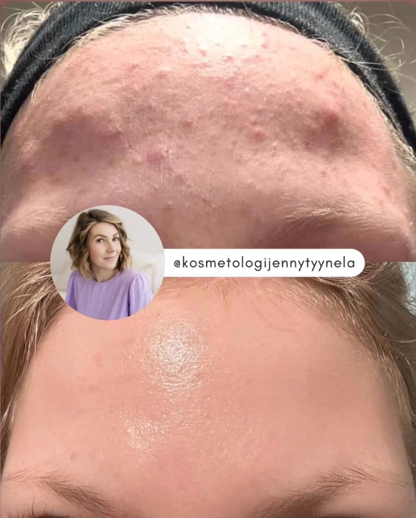 T&auml;m&auml; BiON Skincare Acne Specialistimme @kosmetologijennytyynela postaus on pakko jakaa my&ouml;s t&auml;&auml;ll&auml; uudelleen, niin mielet&ouml;n muutos 💜

@kosmetologijennytyynela : &rdquo;Sain asiakkaalta kuvaviestin saatesanoilla 💌?