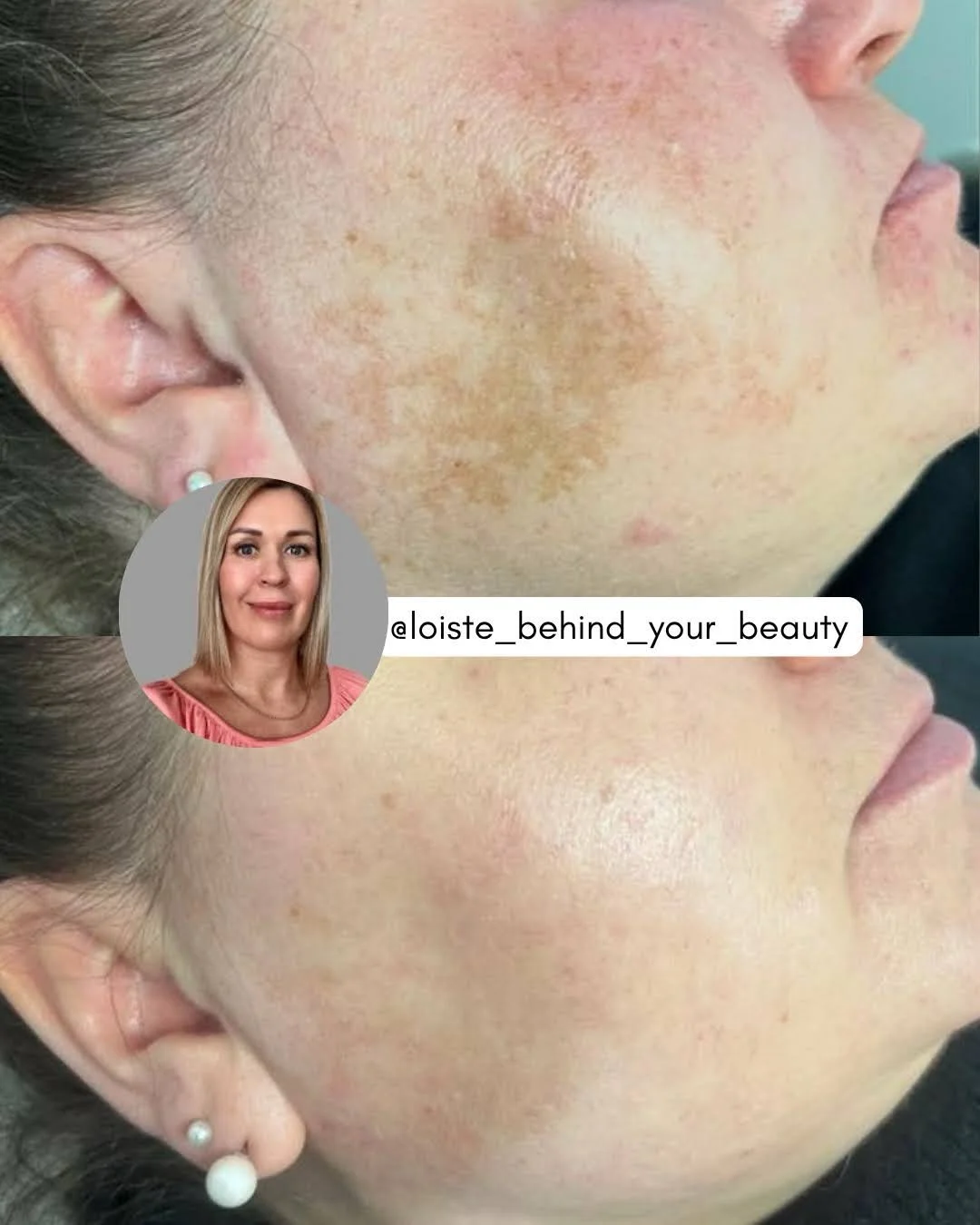 Pigmenttimuutosten hoidossa suurin haaste ei ole l&ouml;yt&auml;&auml; vain kirkastavaa tuotetta, vaan l&ouml;yt&auml;&auml; formulointi, joka todella pystyy vaikuttamaan my&ouml;s vaativiin pigmenttimuutoksiin. Vain harvat tuotteet kohdistuvat saman