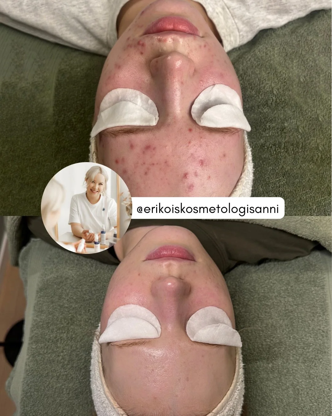 9 kuukautta. Ei pikaratkaisua, vaan ihon toiminnan pitk&auml;j&auml;nteist&auml; tasapainottamista BiON Skincare hoitomenetelm&auml;ll&auml; 💜

Aknen hallinta on mahdollista, kun hoito perustuu johdonmukaiseen suunnitelmaan, oikeisiin hoitotuotteisi