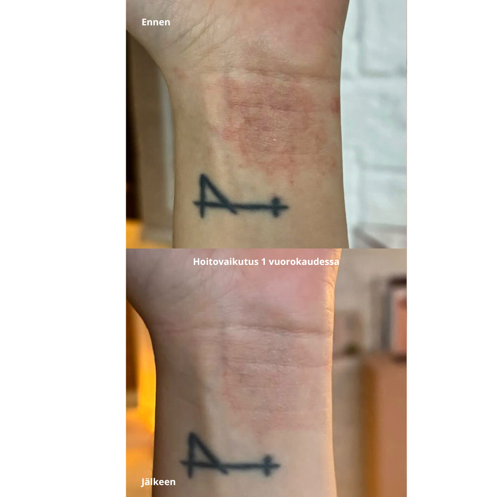 purifyingmist-hypokloorihapposuihke-bionskincare-ihottuma-ennenjälkeen.png