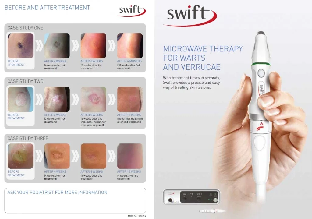 Swift® Microwave Therapy Treatment For Verruca & Wart