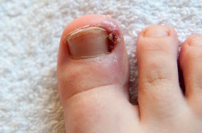An Atlas of Nail Disorders, Part 7 | Consultant360