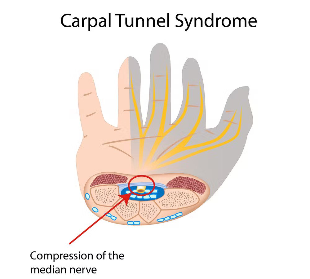Why MSK Is A Great Carpal Tunnel Syndrome Treatment