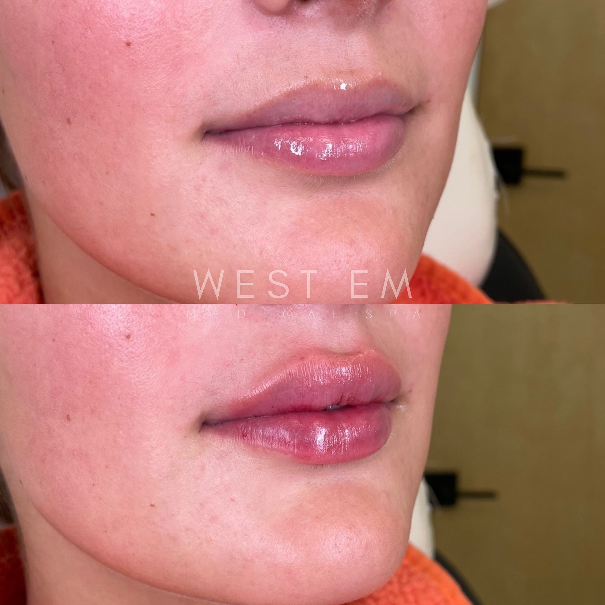 LIP FILLER 

Purpose: Add hydration, shape, or volume to the lips while keeping them looking as natural as possible!​​​​​​​​​​​​​​​​
​​​​​​​​​​​​​​​​
Cost: $700 for a whole syringe, $600 for members
⠀⠀⠀⠀⠀⠀⠀⠀⠀​​​​​​​​​​​​​​​​
$450 for a half syringe​​