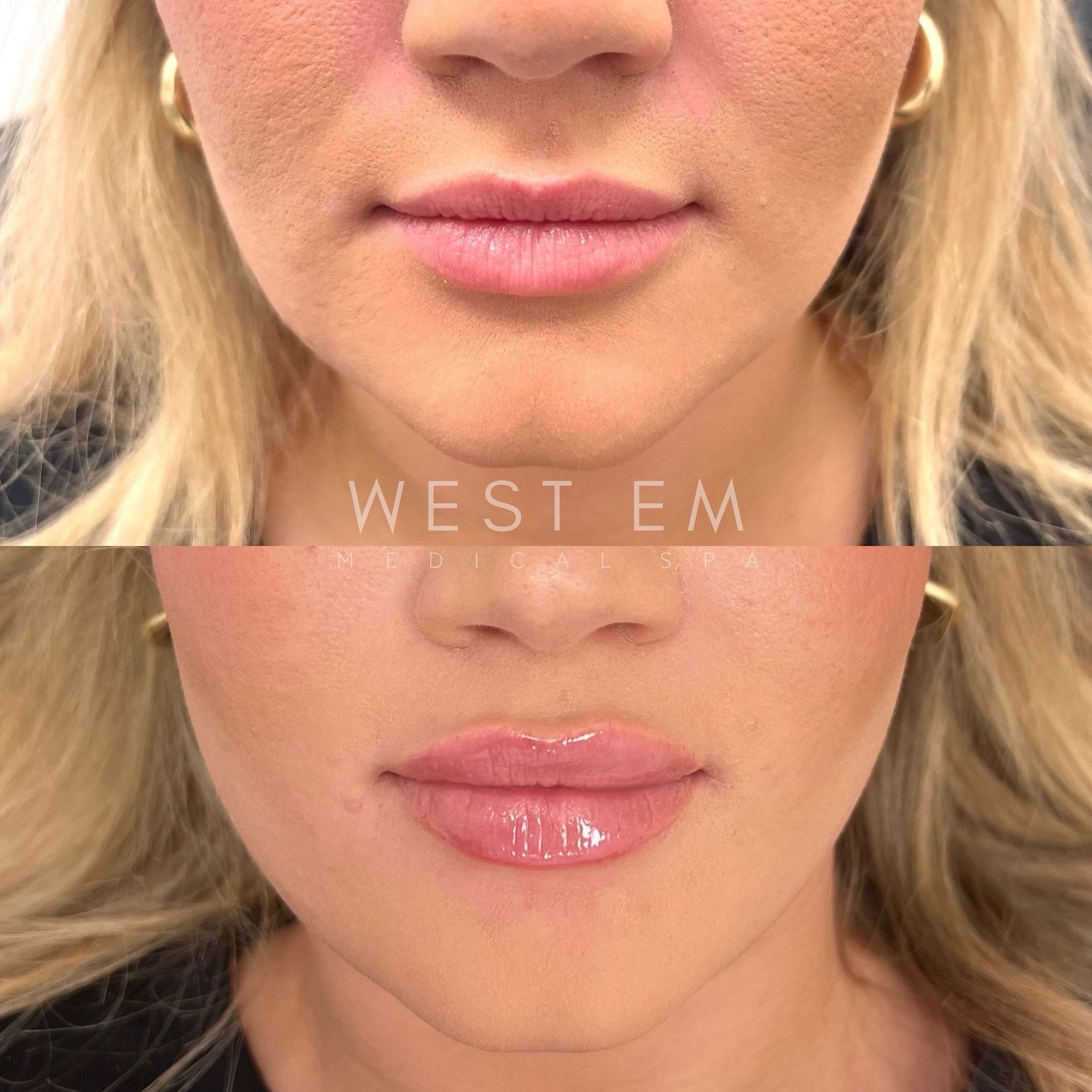 LIP FILLER

Throwback to one of our favorite before and afters! 

Purpose: Add hydration, shape, or volume to the lips while keeping them looking as natural as possible!​​​​​​​​​​​​​​​​
​​​​​​​​​​​​​​​​
Cost: $700 for a whole syringe, $600 for member