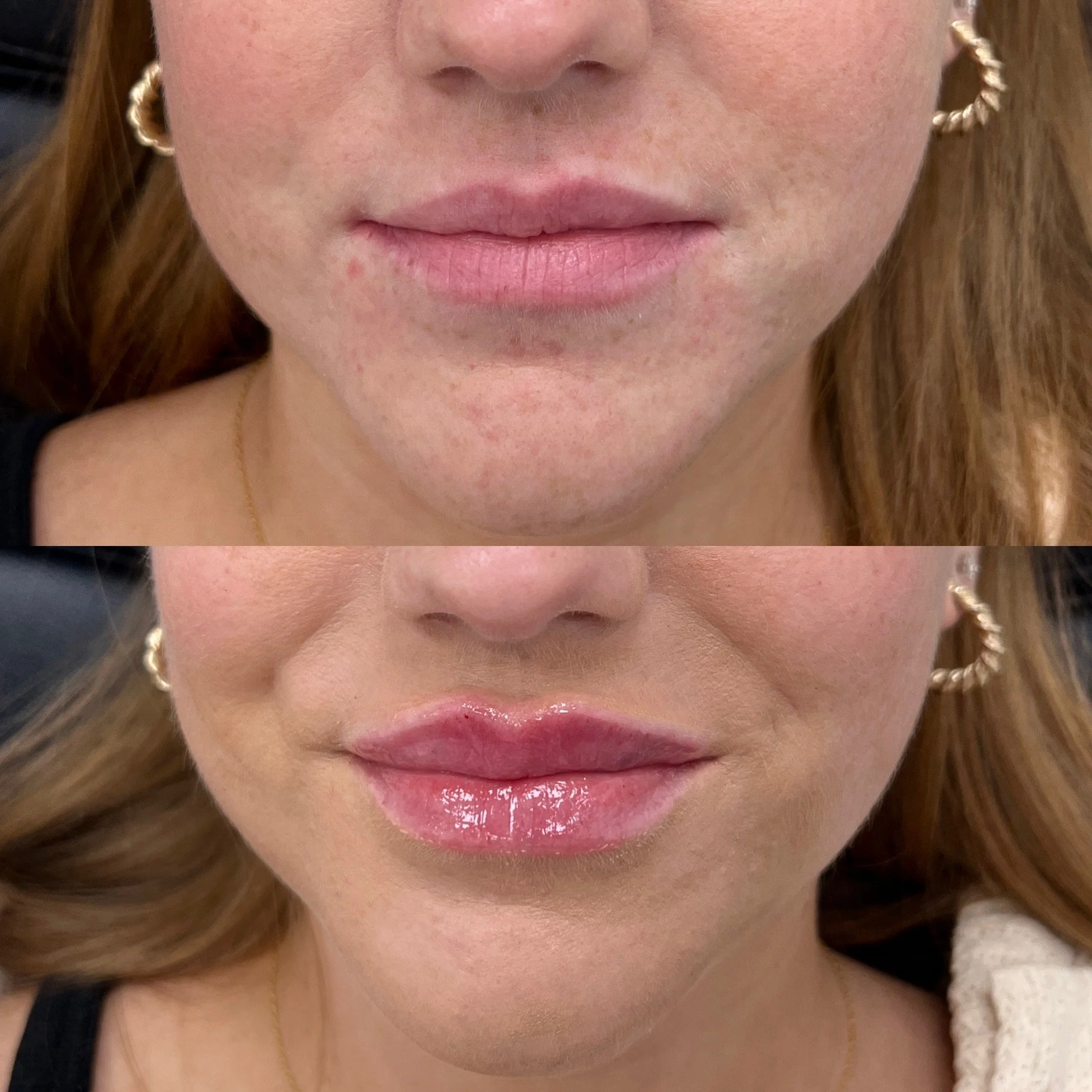 1 Syringe of Lip Filler