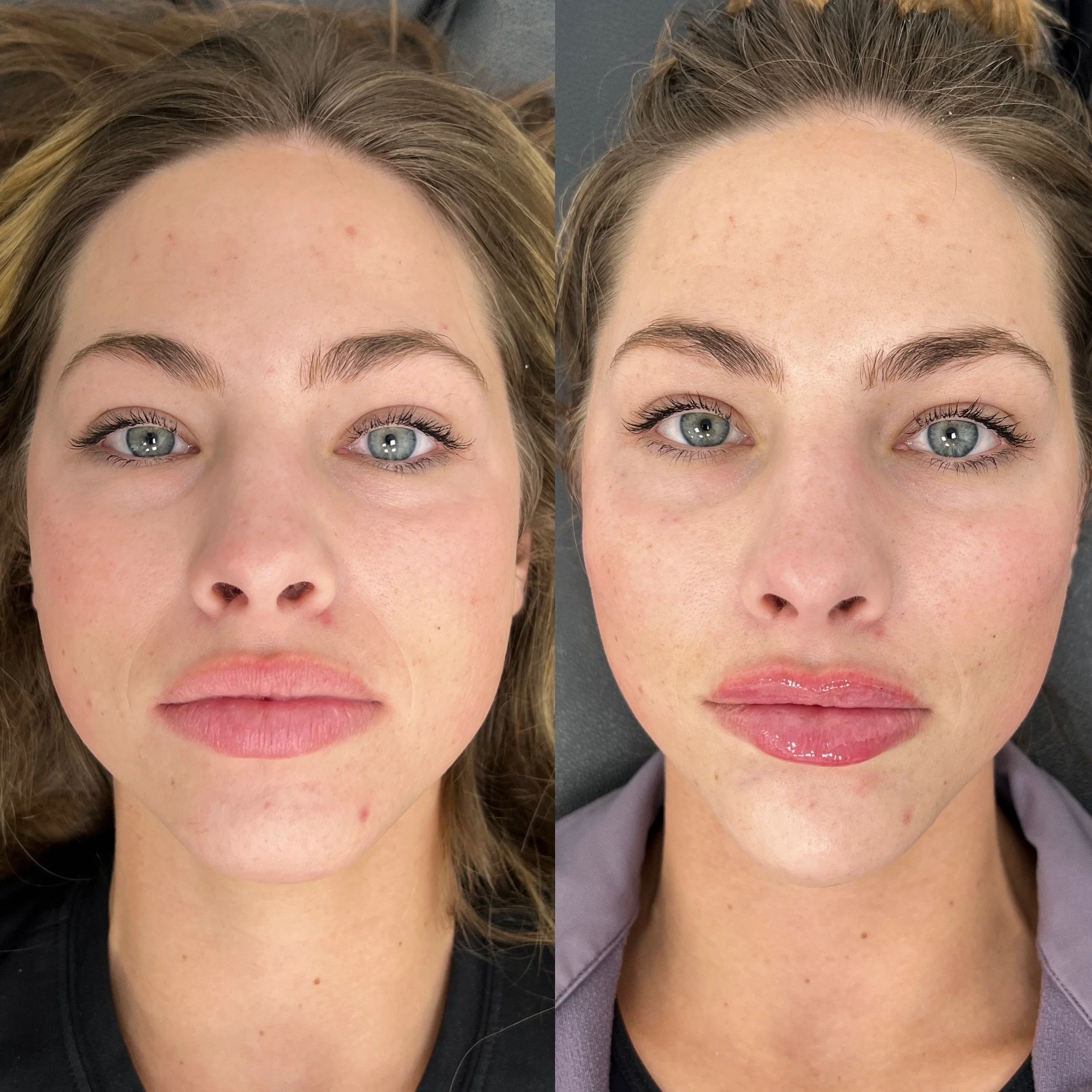 Full Facial Filler Balancing 