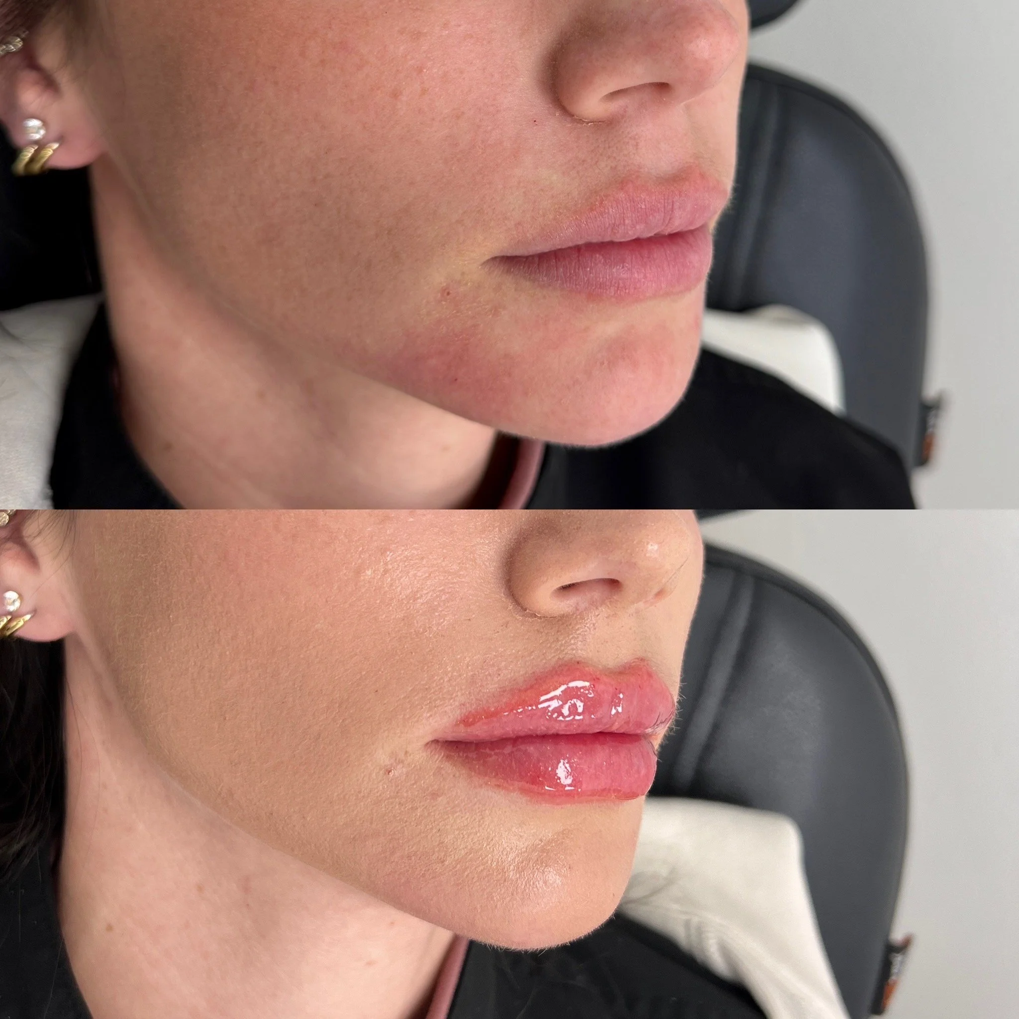 1 Syringe of Lip Filler