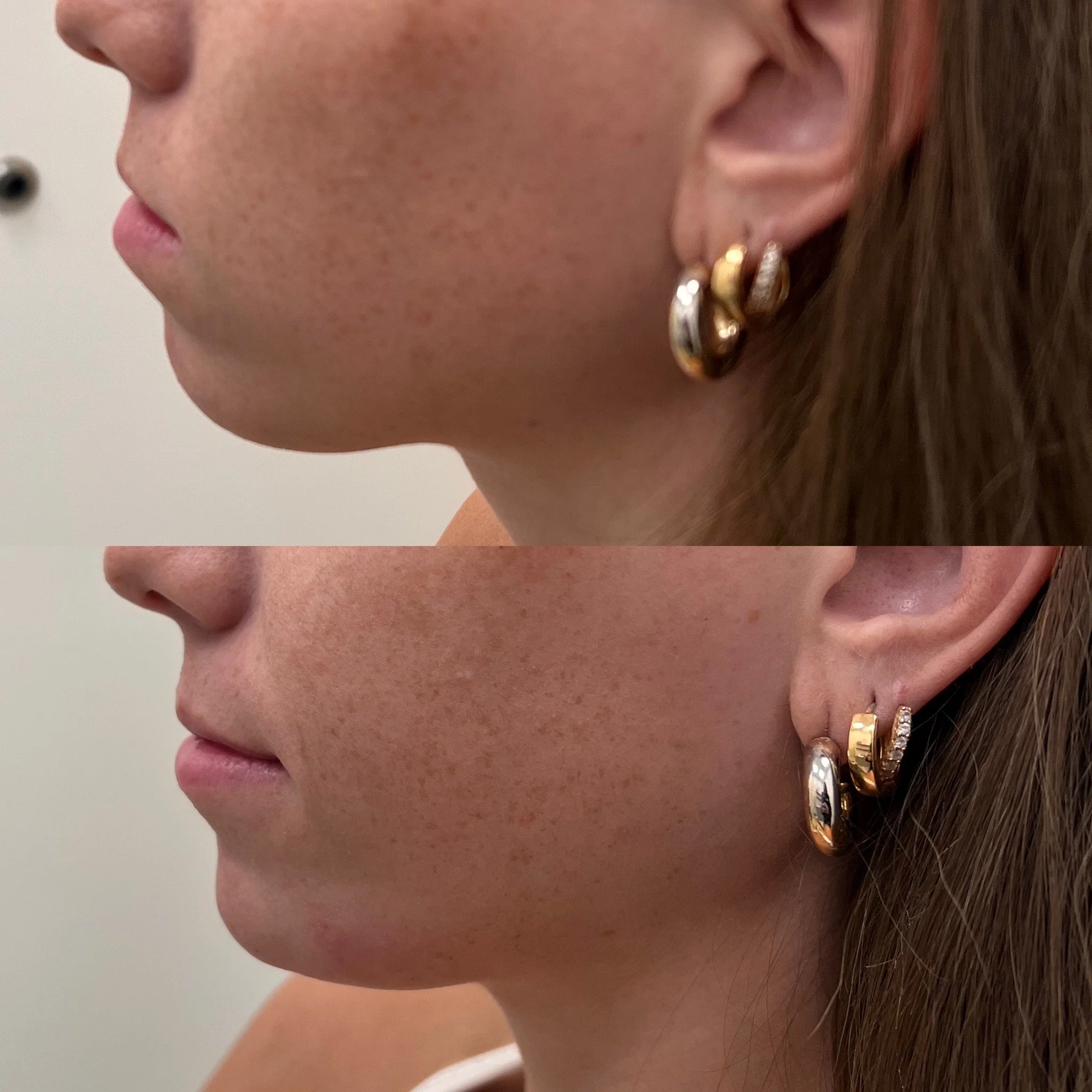 Jaw + Chin Filler