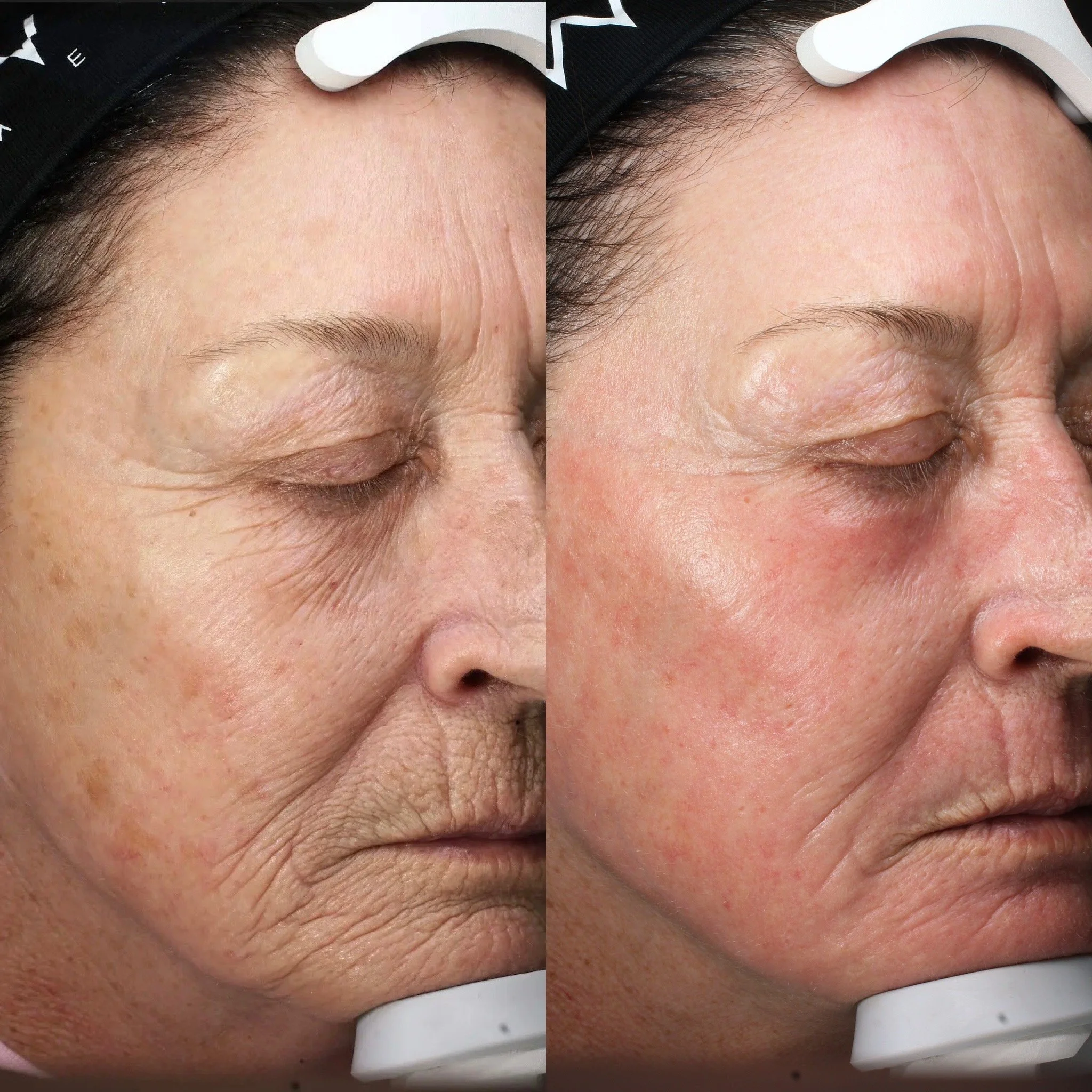 1 Contour TRL Treatment