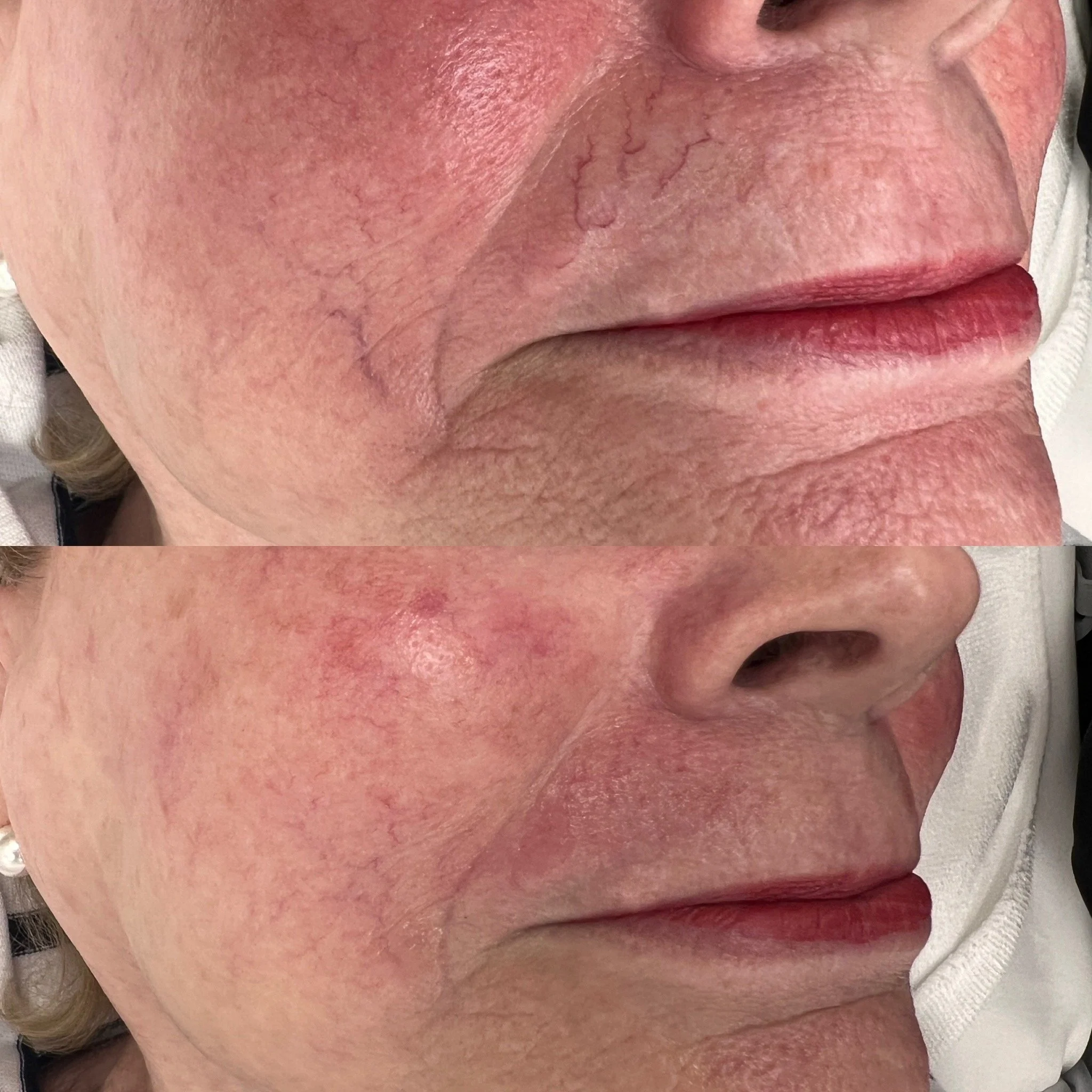 Clear V Vein Treatment