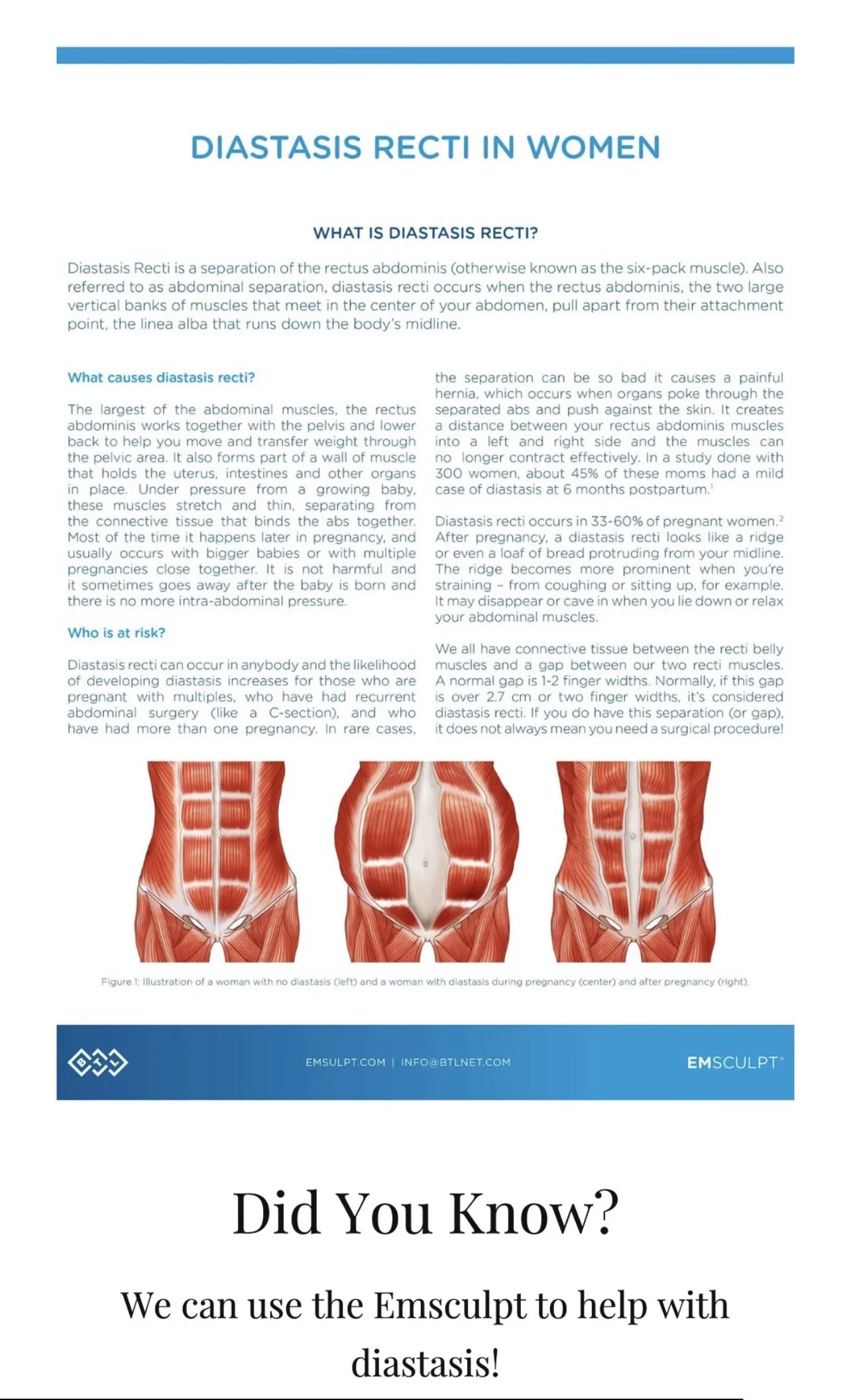 Diagram showing diastasis recti in women, illustrating separation of abdominal muscles and affected area