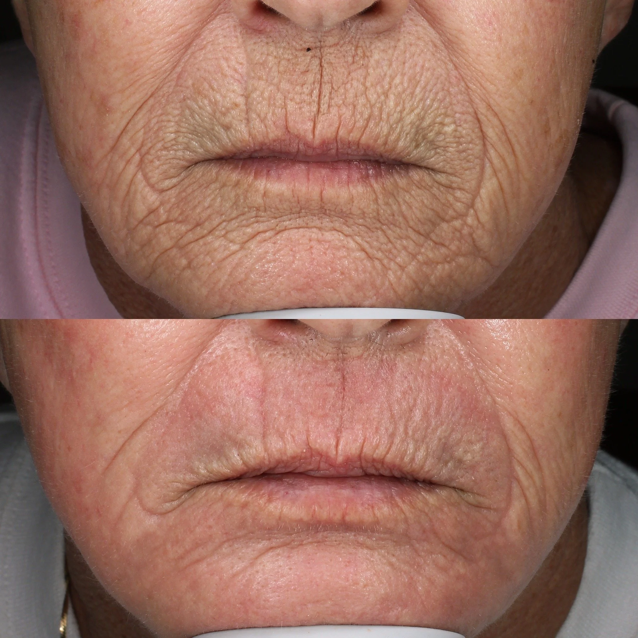 1 Contour TRL Treatment