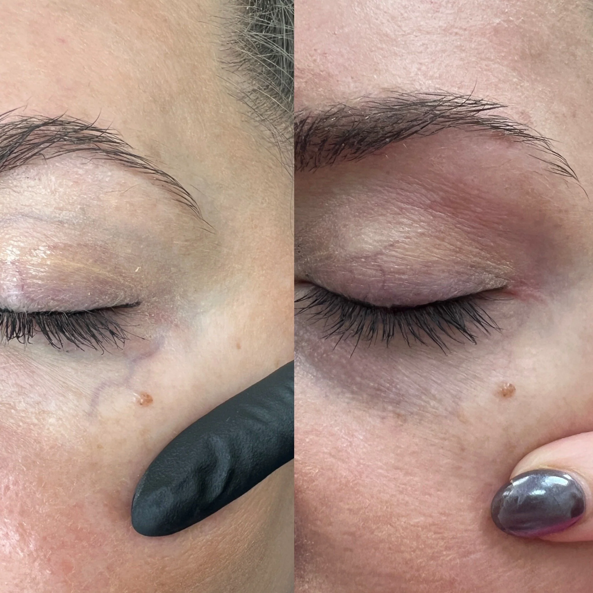 Clear V Vein Treatment