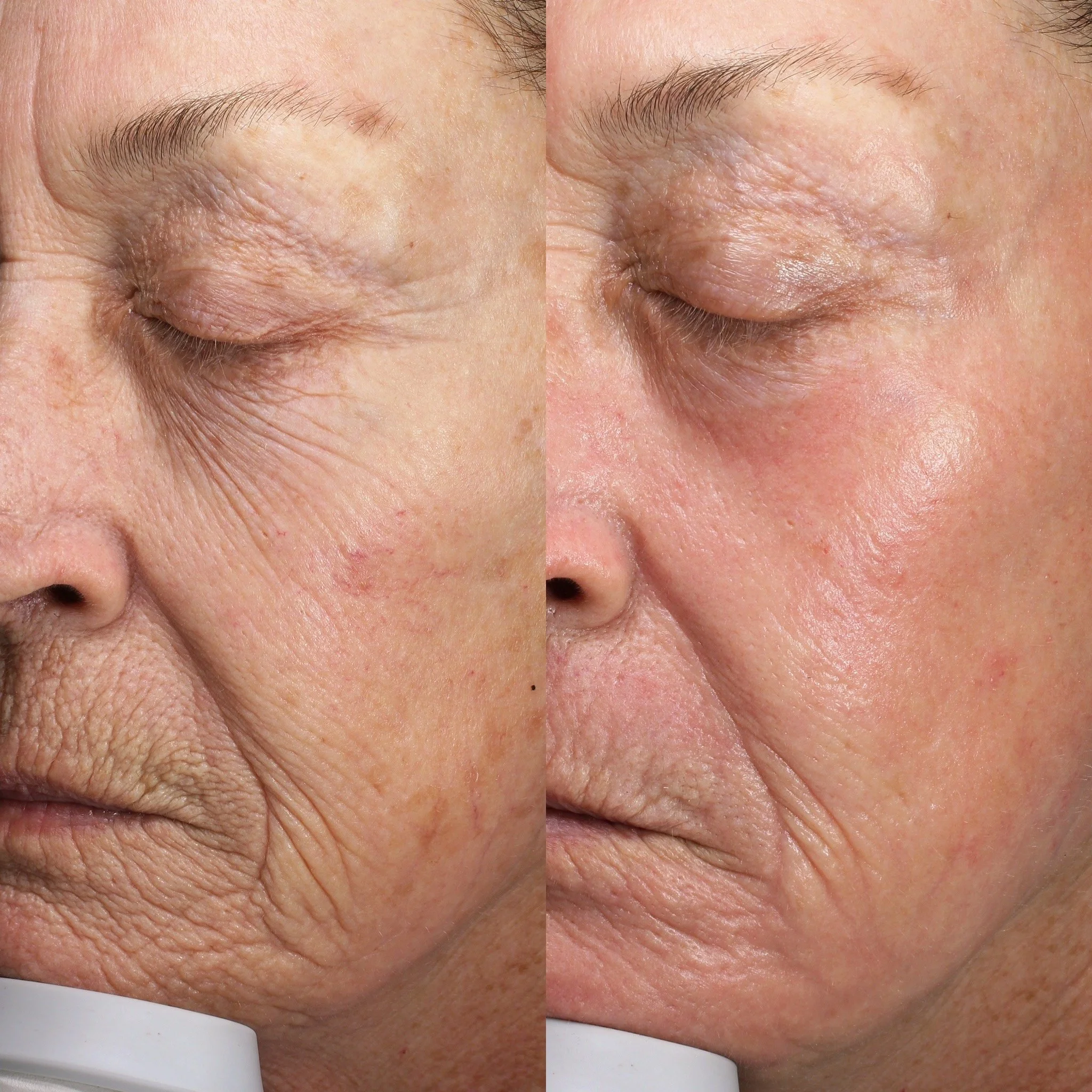 1 Contour TRL Treatment