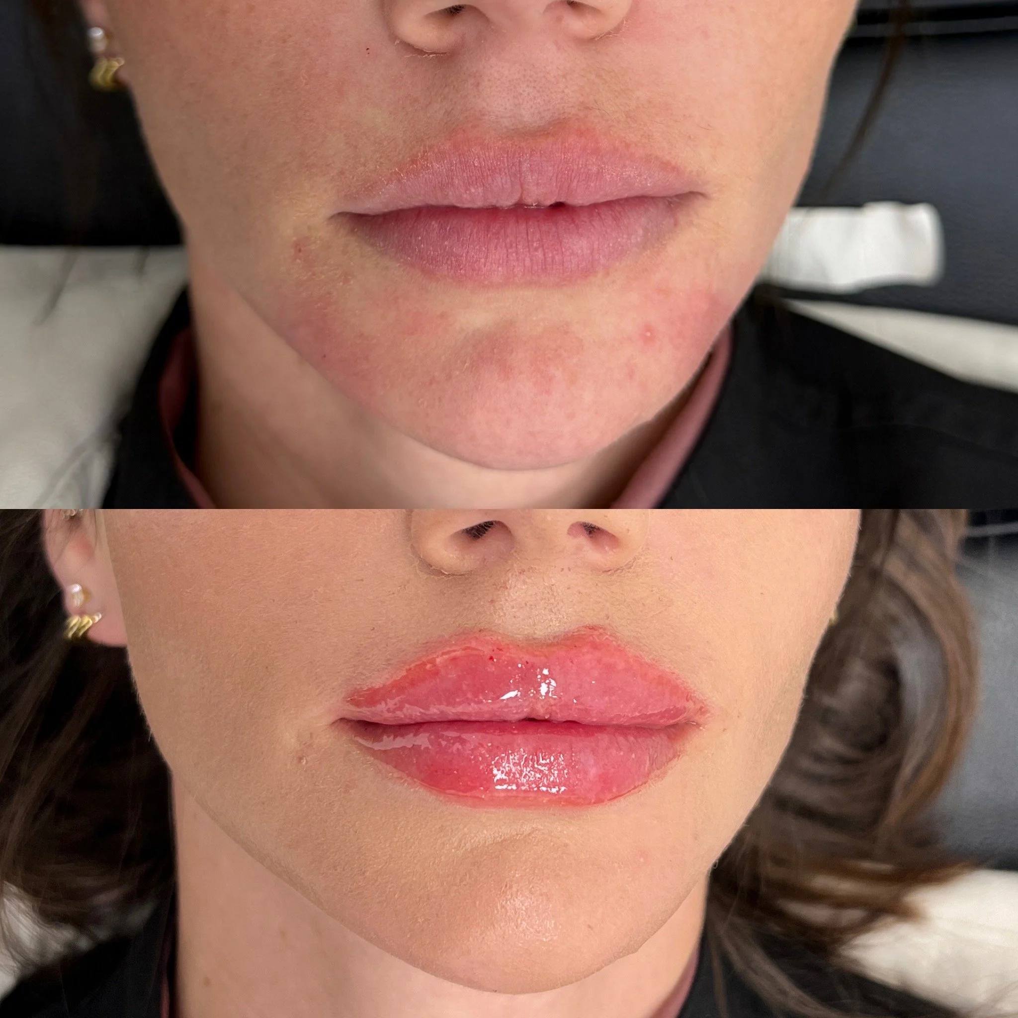 1 Syringe of Lip Filler