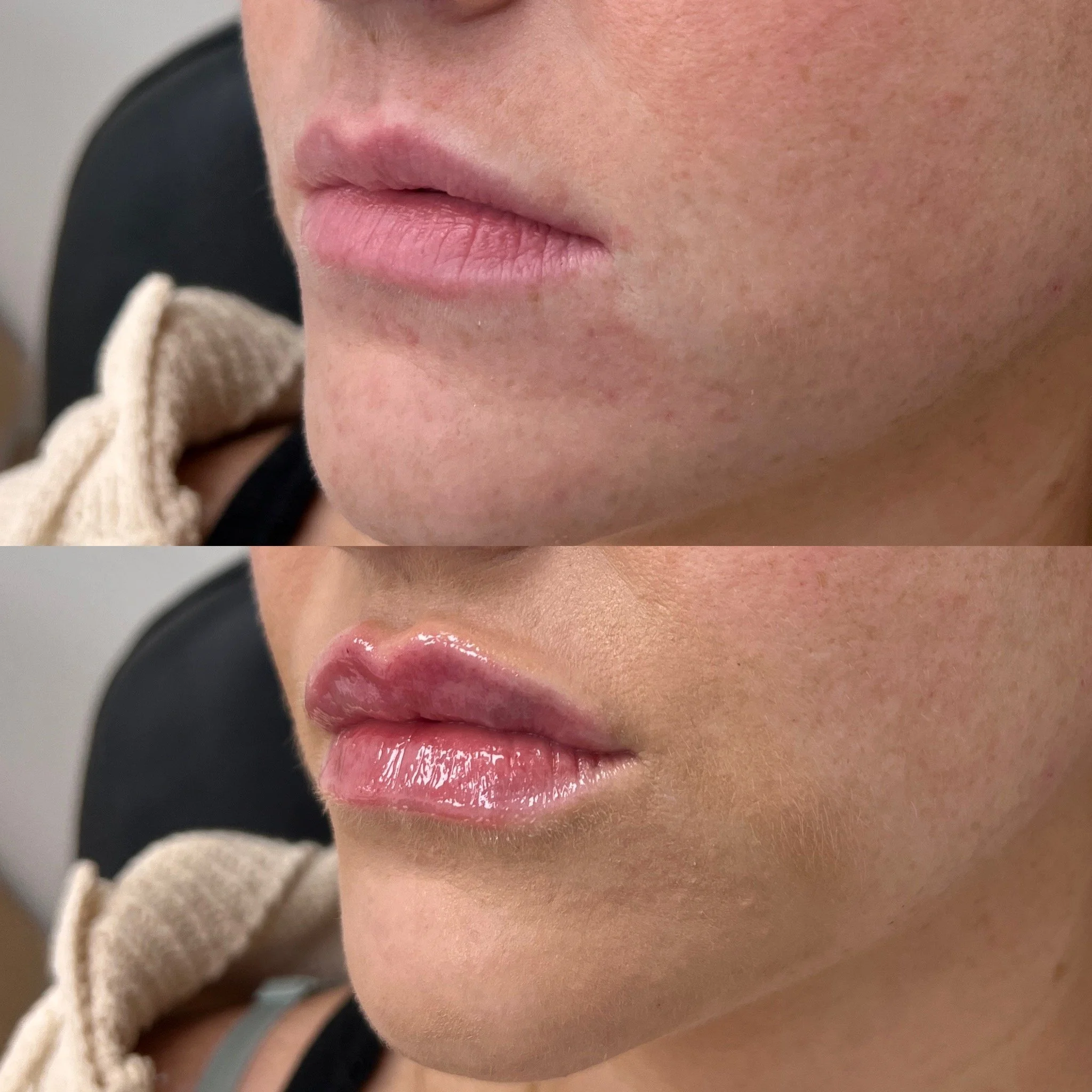 1 Syringe of Lip Filler