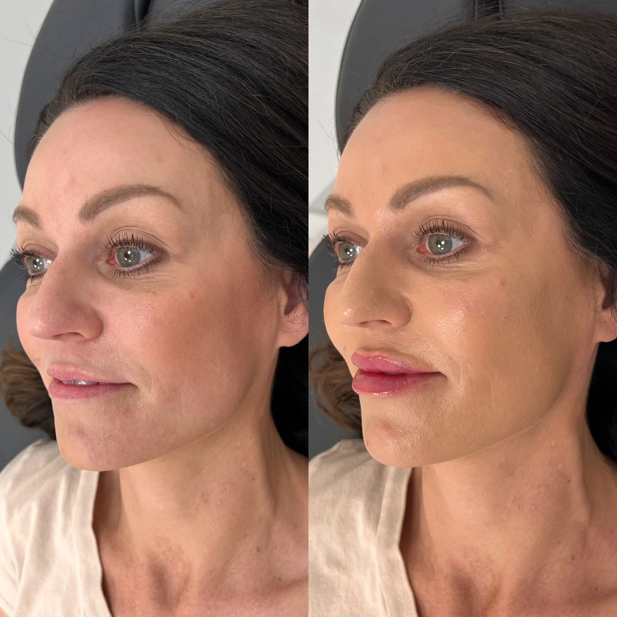 Full Facial Filler Balancing 