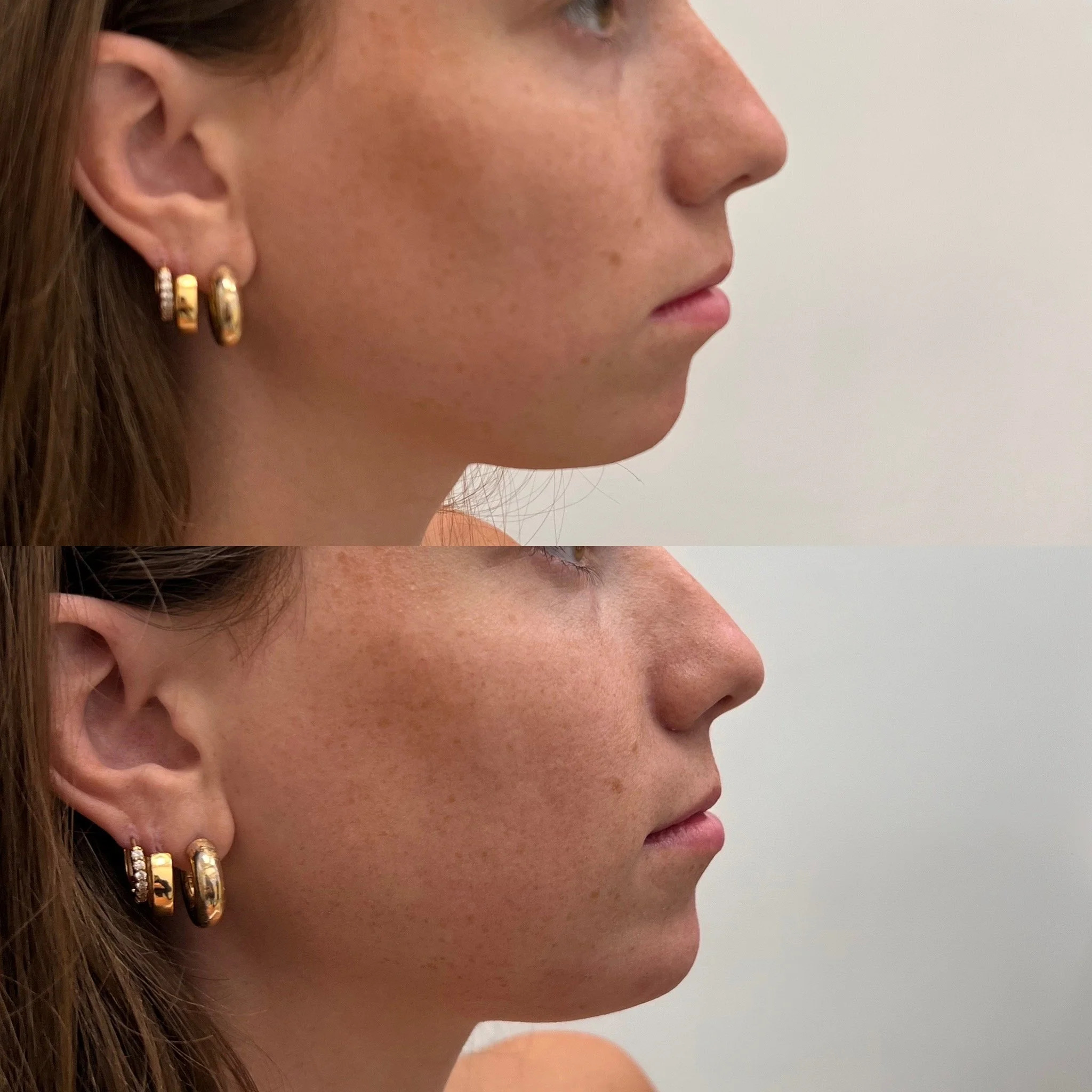 Jaw + Chin Filler