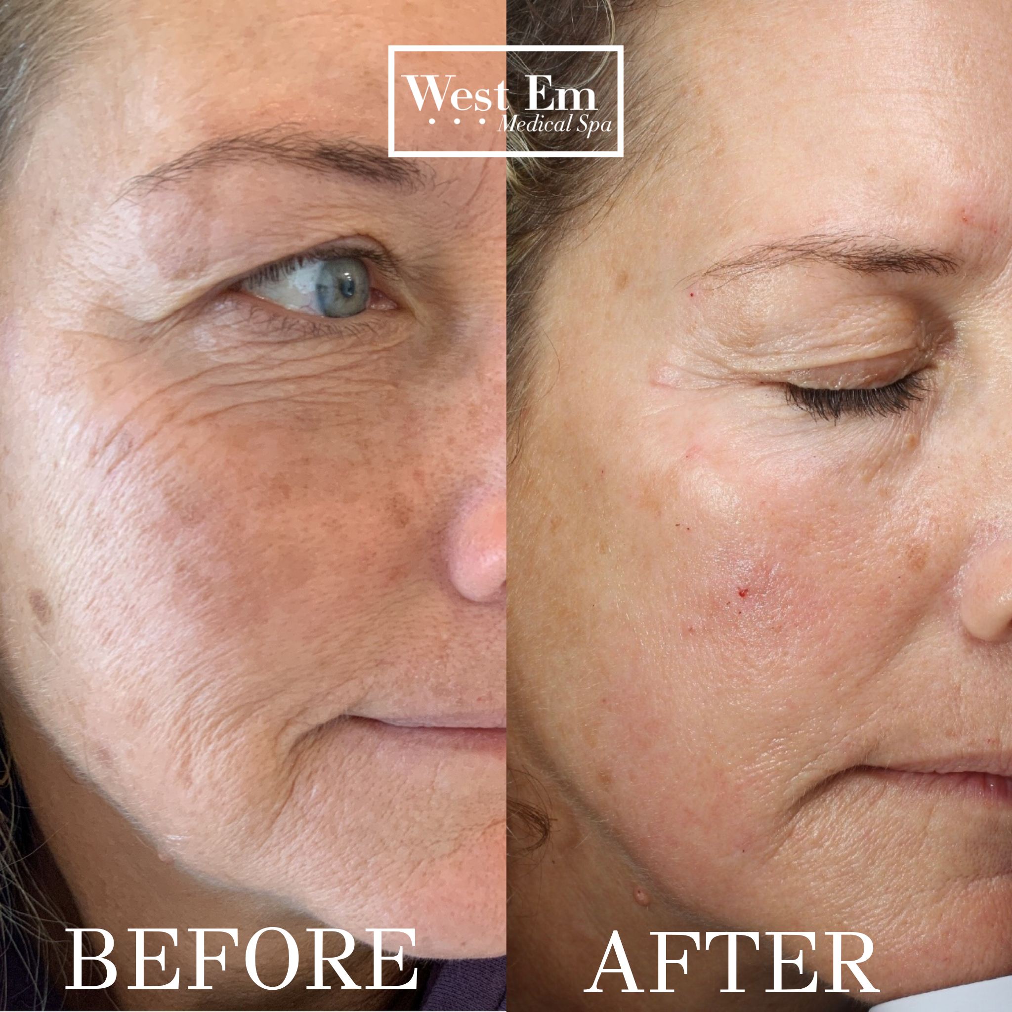 Side-by-side before and after photo showing patient results following a 3-month skincare regimen with Halo laser, BBL, and Botox at West Em Medical Spa