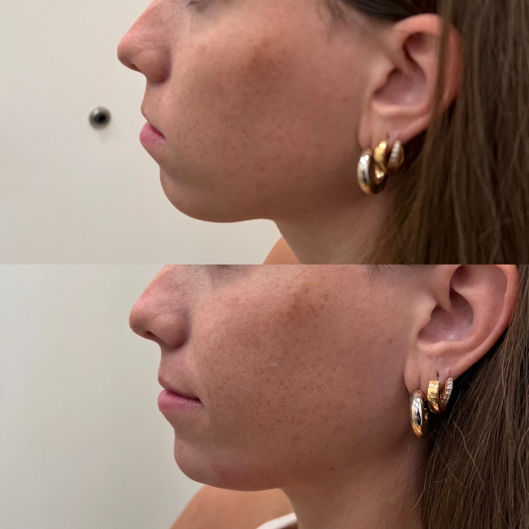 Jaw + Chin Filler