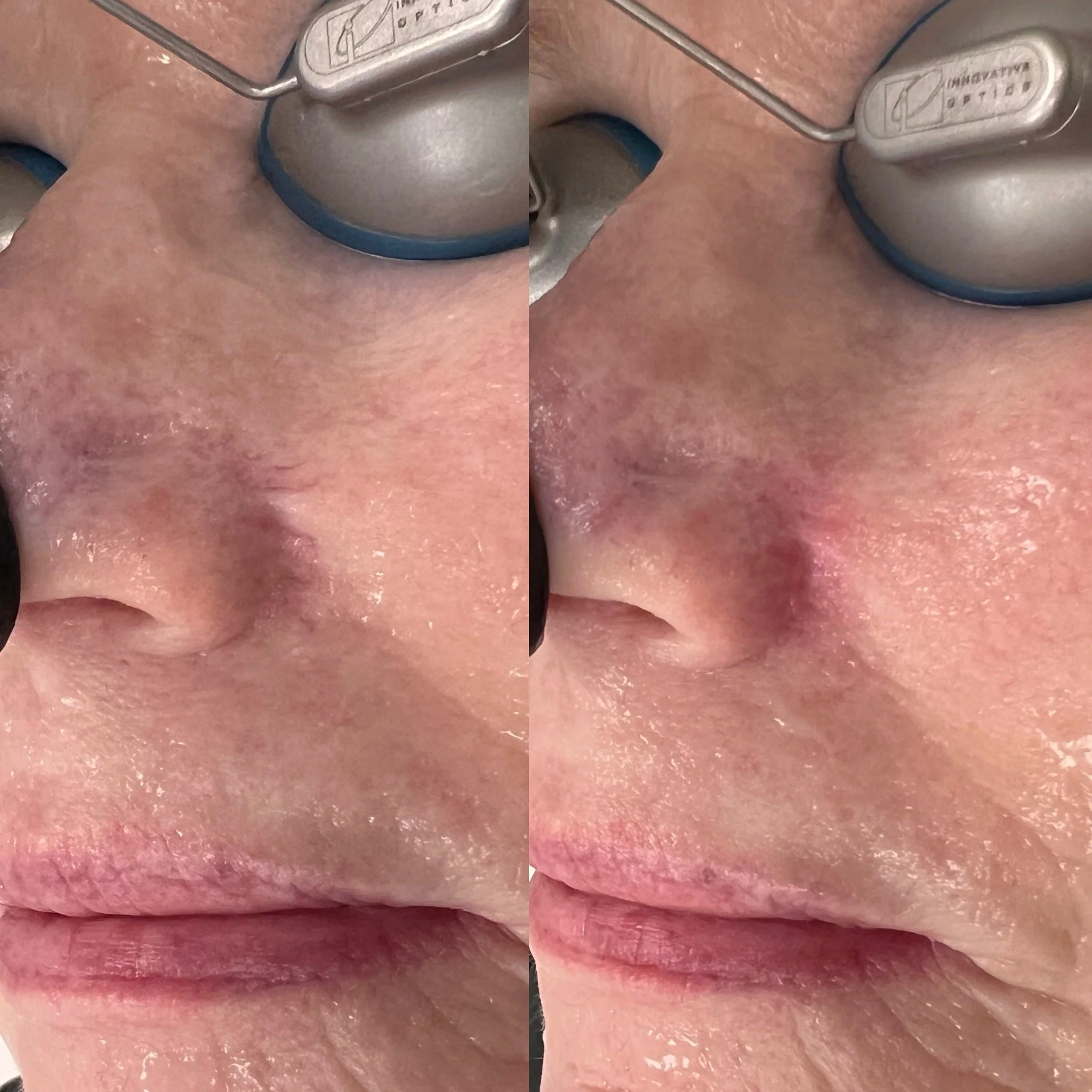 Clear V Vein Treatment