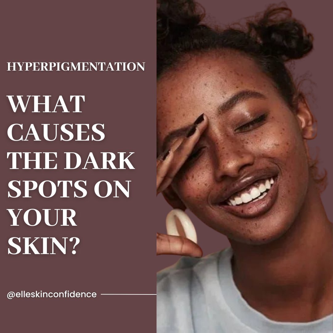 What is hyperpigmentation and why does it seem more common in darker skin tones?

Let's talk about it ⬇️

👉🏾 Hyperpigmentation is a common, usually harmless condition in which patches of skin become darker in color than the normal surrounding skin.