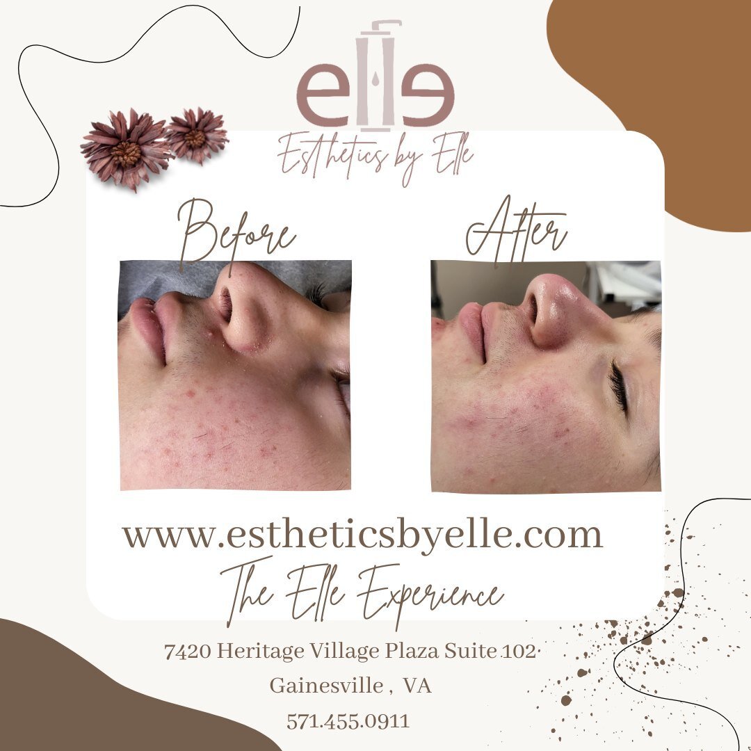 Back to school time. Did you wait until the last minute to care about your skin? Fret not! Esthetics by Elle has you covered. Even if you get ONE, yes ONE treatment before school begins, you will see results. Let good skincare be apart of your back t