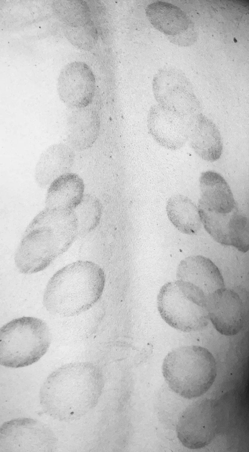 A black and white image showing post cupping session marks by Rein Short, LAc.