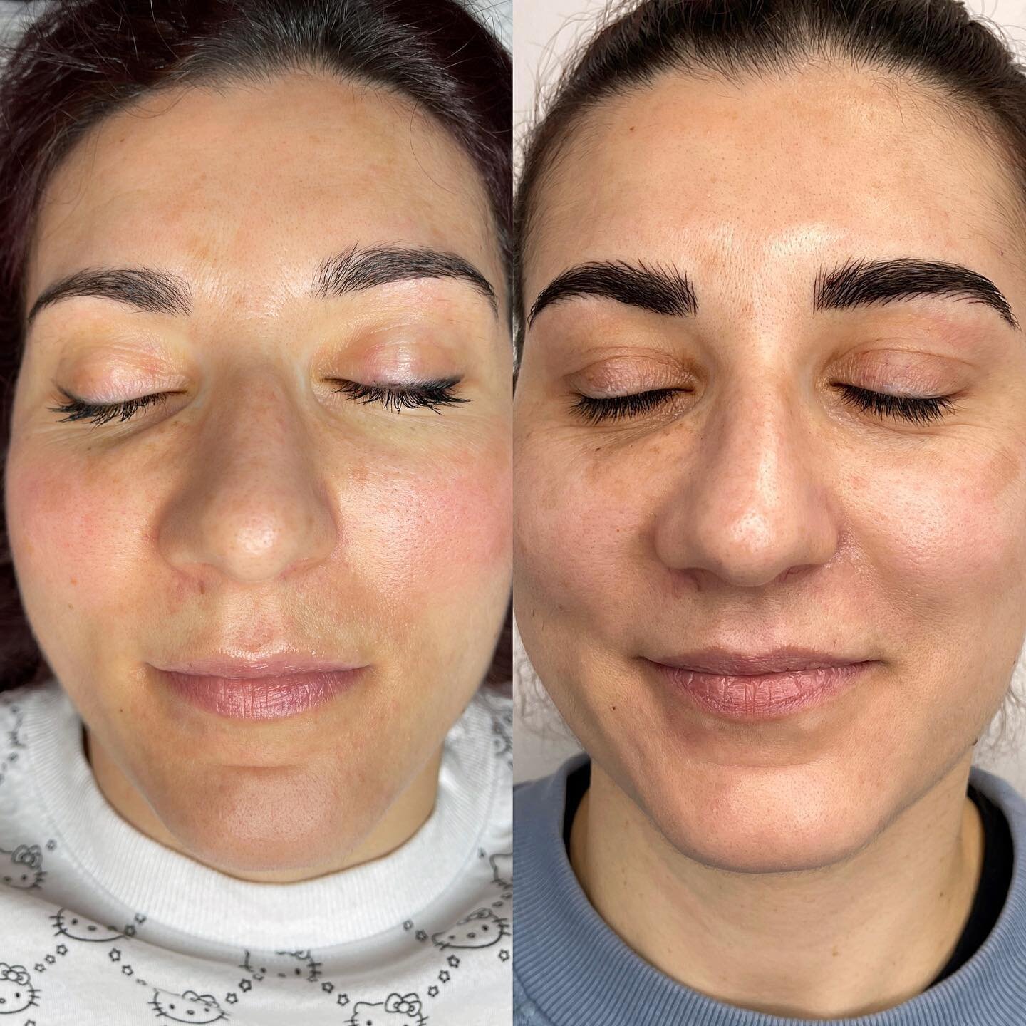 ✨Microblading Magic🪄
Uneven / Asymmetrical brows? I got you📏📐
(Before-After 2 sessions)💖

It is very common to have a brow higher than the other. 
Although its very hard in some cases to make the brows perfectly symmetrical I always try my best t