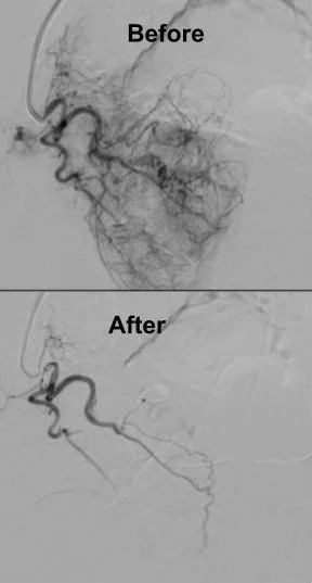 Prostate Artery Embolization — Michael J Drabkin, MD