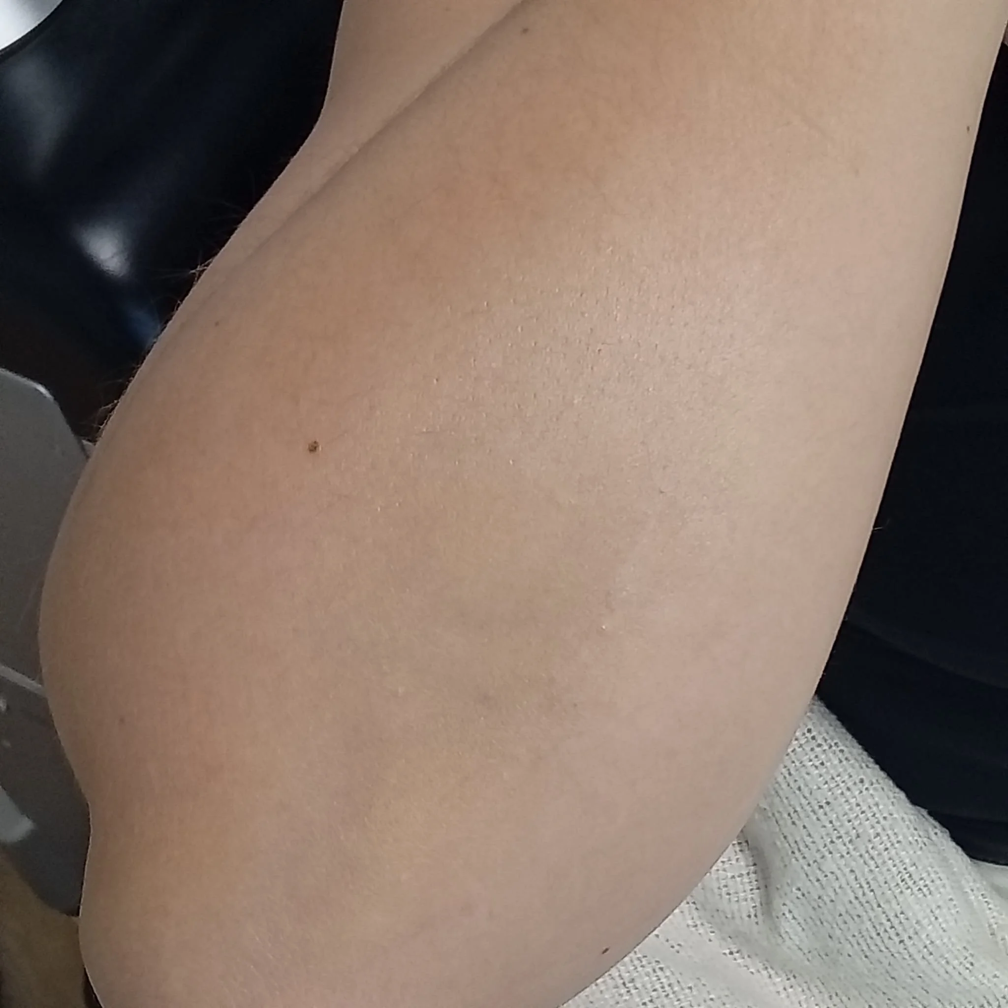 Tatuointi käsivarressa tatuoinninpoiston jälkeen