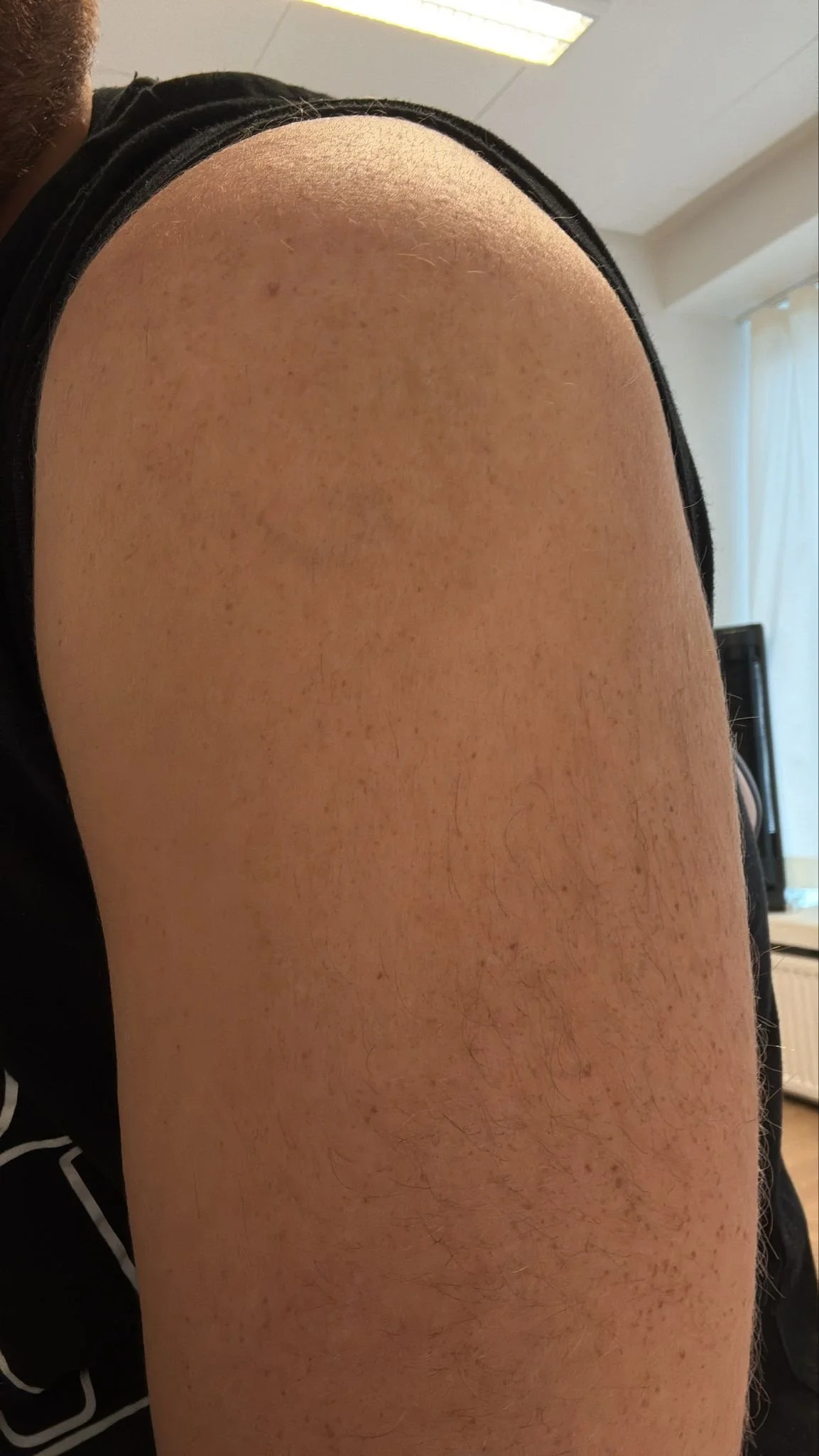 Tatuointi käsivarressa tatuoinninpoiston jälkeen