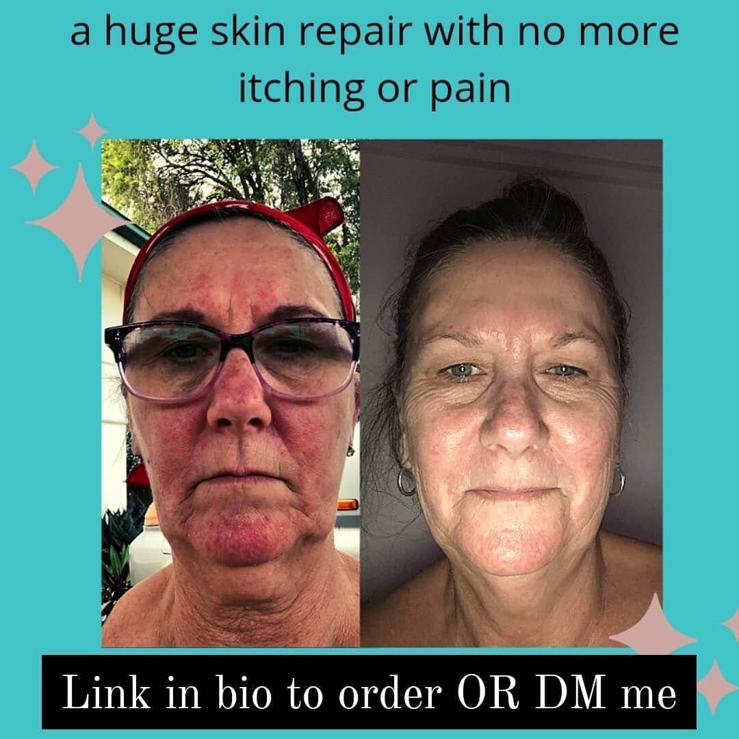Rohr Remedy is now back in stock.
🙌
This is how beautifully these bush medicine combined with science products help our skin heal.
Many ask me what clean skin care I use, I always direct them to Rohr!
This was a huge result in only 2 days of using t