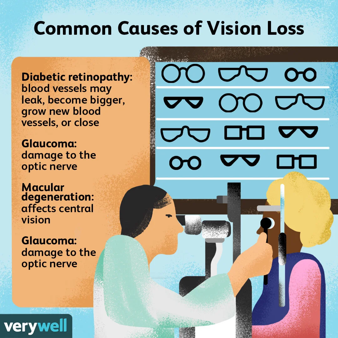 Some vision loss happens suddenly. Other times, it happens gradually.

For more information on some of these most common causes of vision loss, follow the link in our bio.

🎨: @micbu