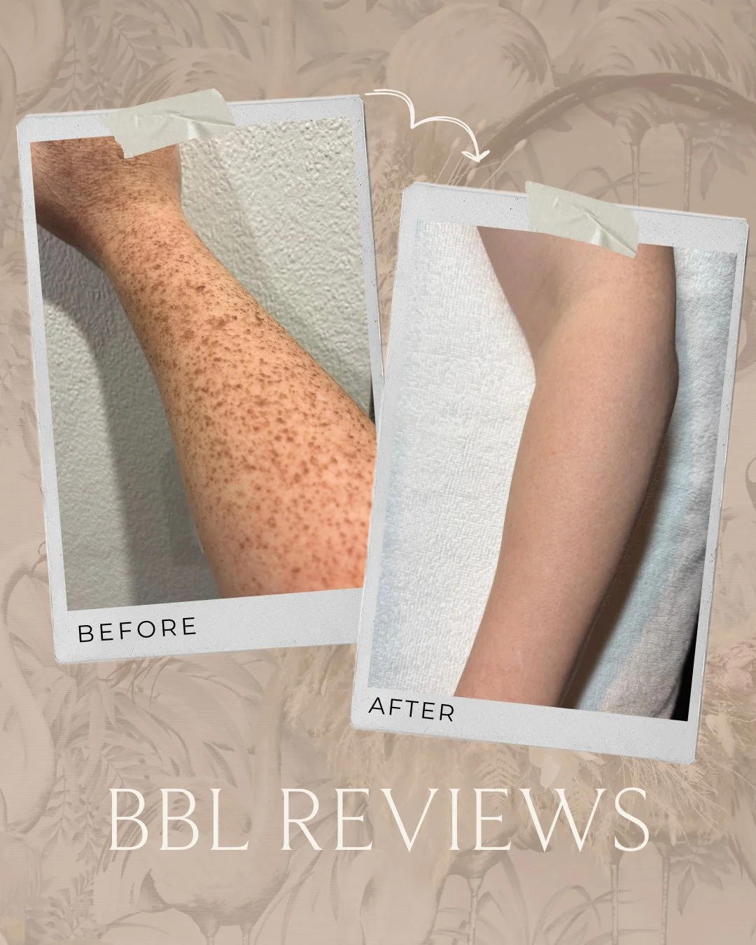✨ What our clients are saying about their BBL treatments ✨⁠
Look at those results 😍 No downtime. Just results you feel and see.