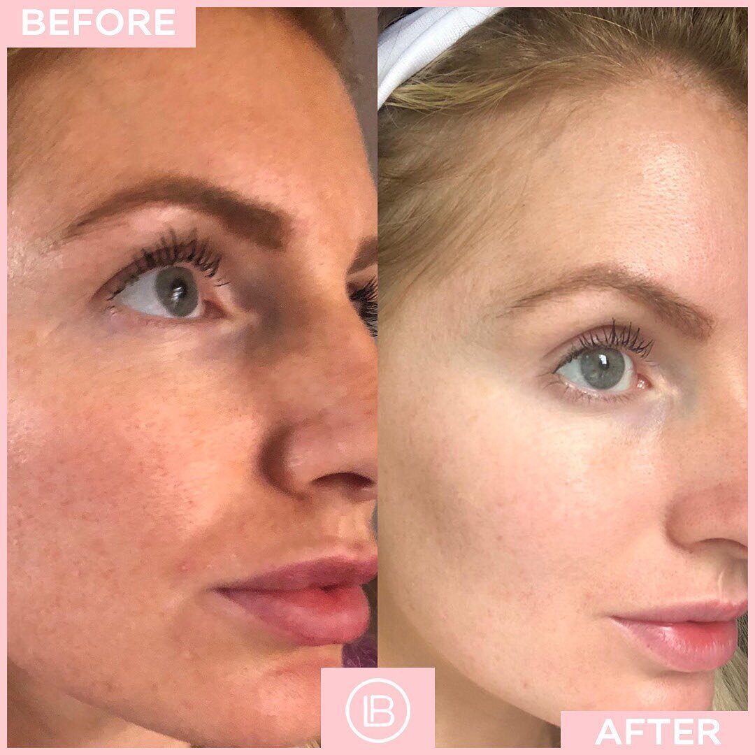 Our best selling PEEL is back 🆘⠀
⠀
Clinic results at home..literally changing the SKINCARE game 💯⠀
⠀
Do you suffer &lsquo;large pores&rsquo; or a &lsquo;dull&rsquo; complexion?🕳⠀
⠀
Beat the rain and get that GLOW☀️

Here is what @rachelfrance89 ha