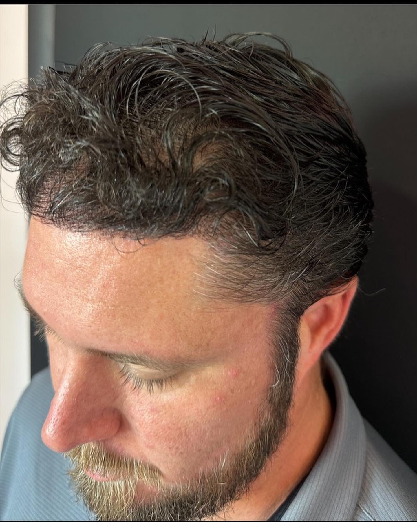 Our FUE hair transplants will grow your natural hair back within months! Permanent results! 

Give us a call to schedule your appointment today! 🤩 (904) 686-2505

#pontevedrabeach #medspamagic #jaxbeach #jaxbeauty #fuehairtransplant #hairgrowthtips