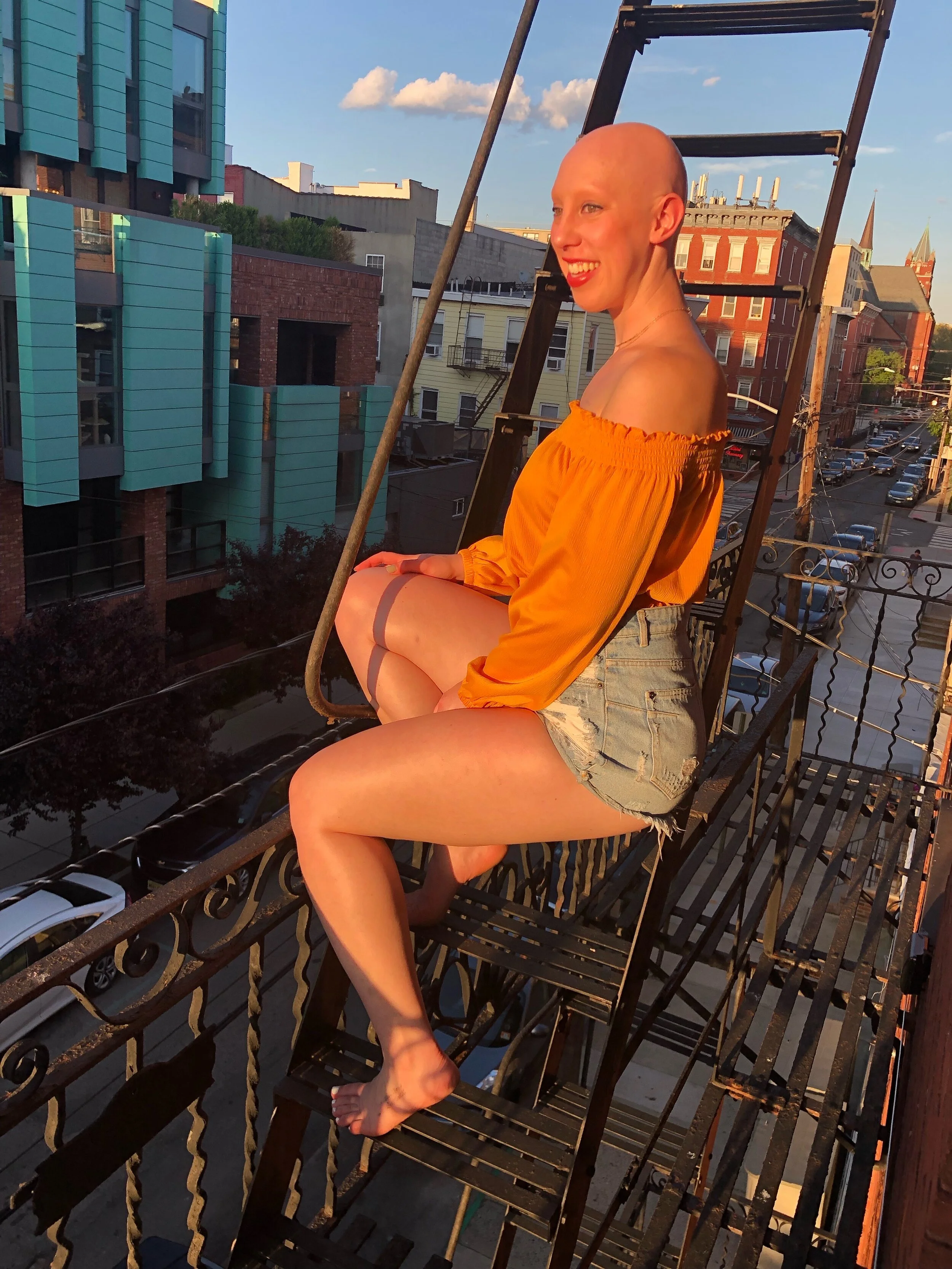 My Story with Alopecia