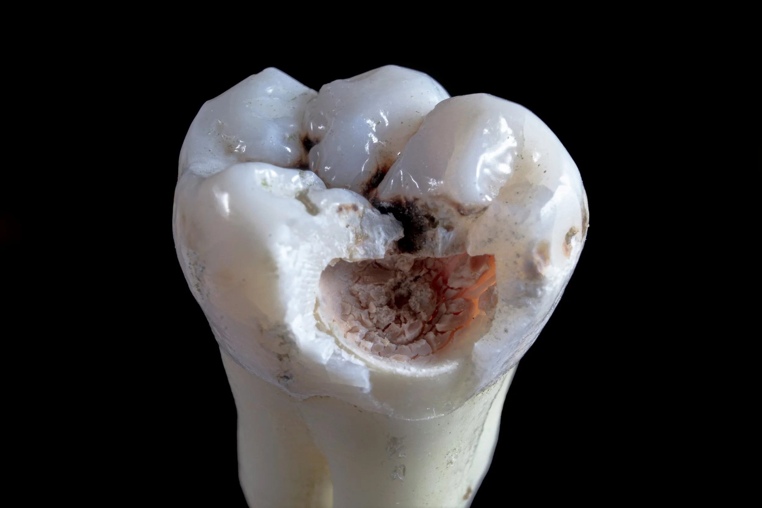 Is This The End For Mercury Fillings?