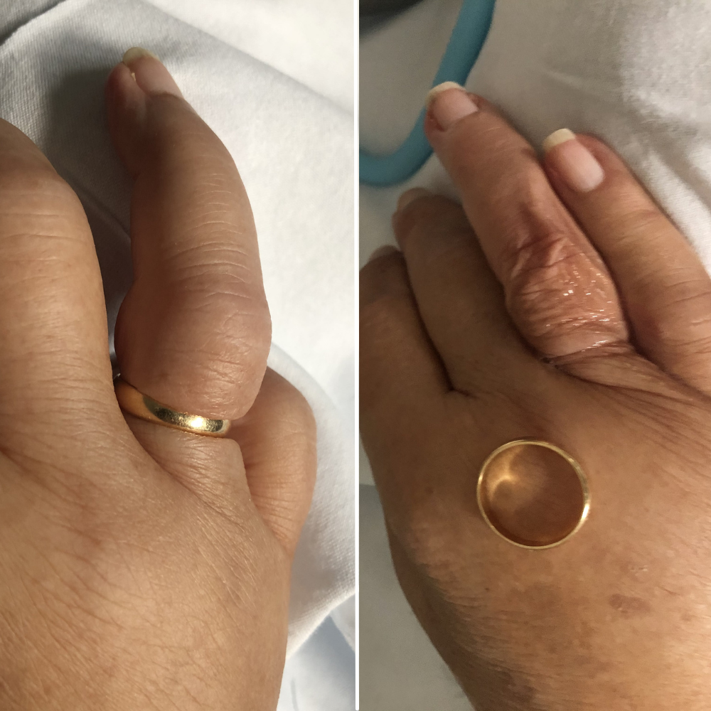 Ring Removal Without Cutting Ring Rescue Compression Device™